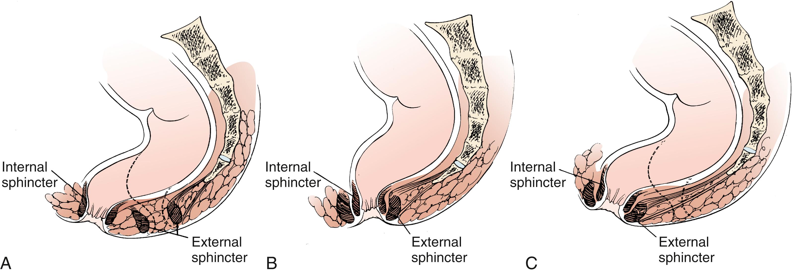 Fig. 19.2, A, Anterior ectopic anus. B, Normal anal anatomy. C, Anterior anal displacement.