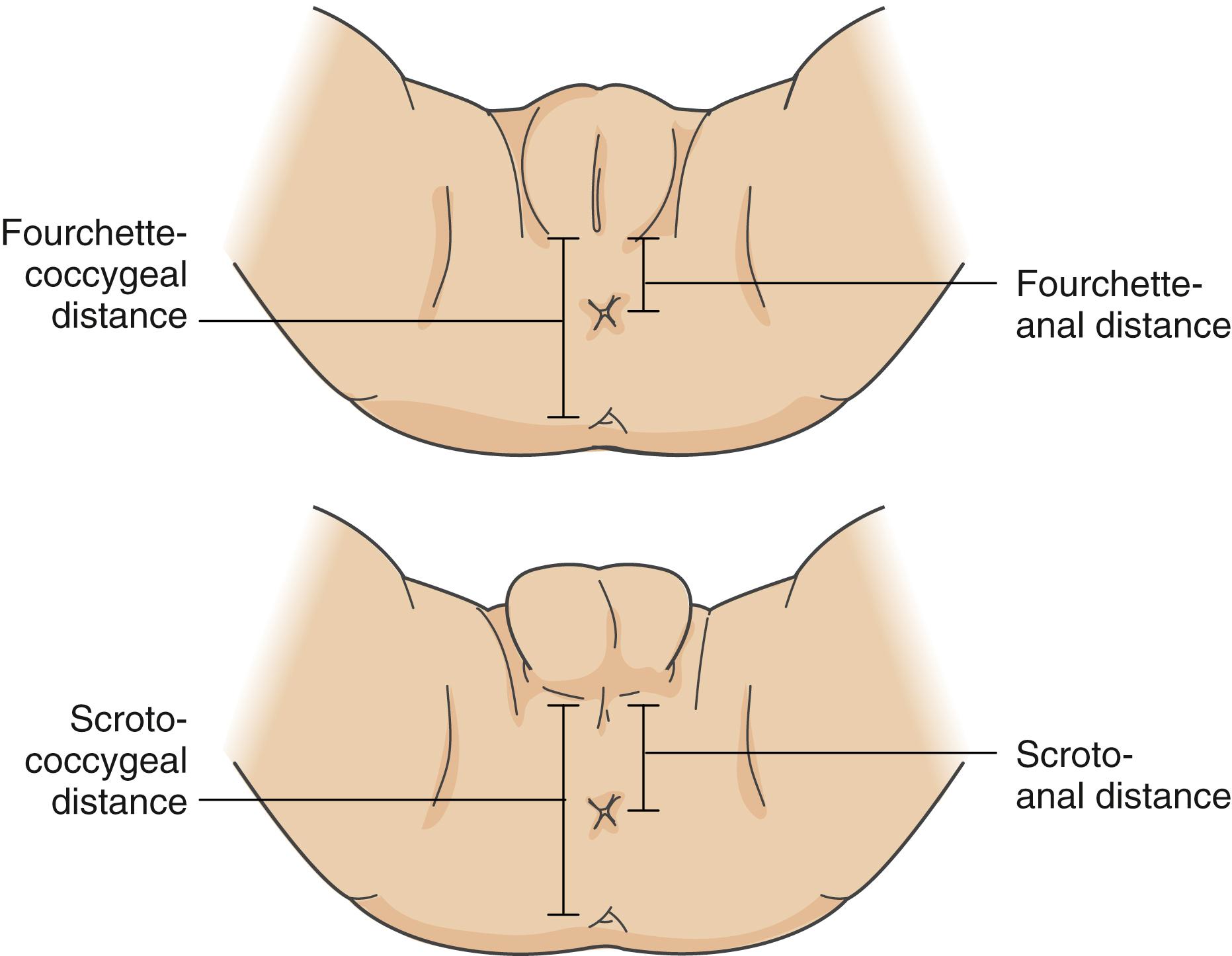 Fig. 19.3, Measuring the anal position index (API) in females and males. The API is defined as the ratio of the distance between the anus and the posterior aspect of the genitals (the fourchette in females and scrotum in males) to the distance between the coccyx and the posterior genitals.