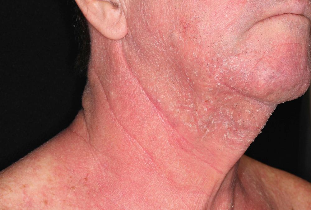 FIG 4.11, This patient developed an allergy to isothiazolinone in his moisturizer.