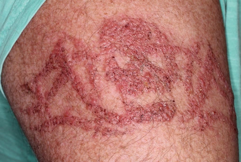 FIG 4.12, This patient had an allergy to paraphenylenediamine allergy from a henna tattoo.