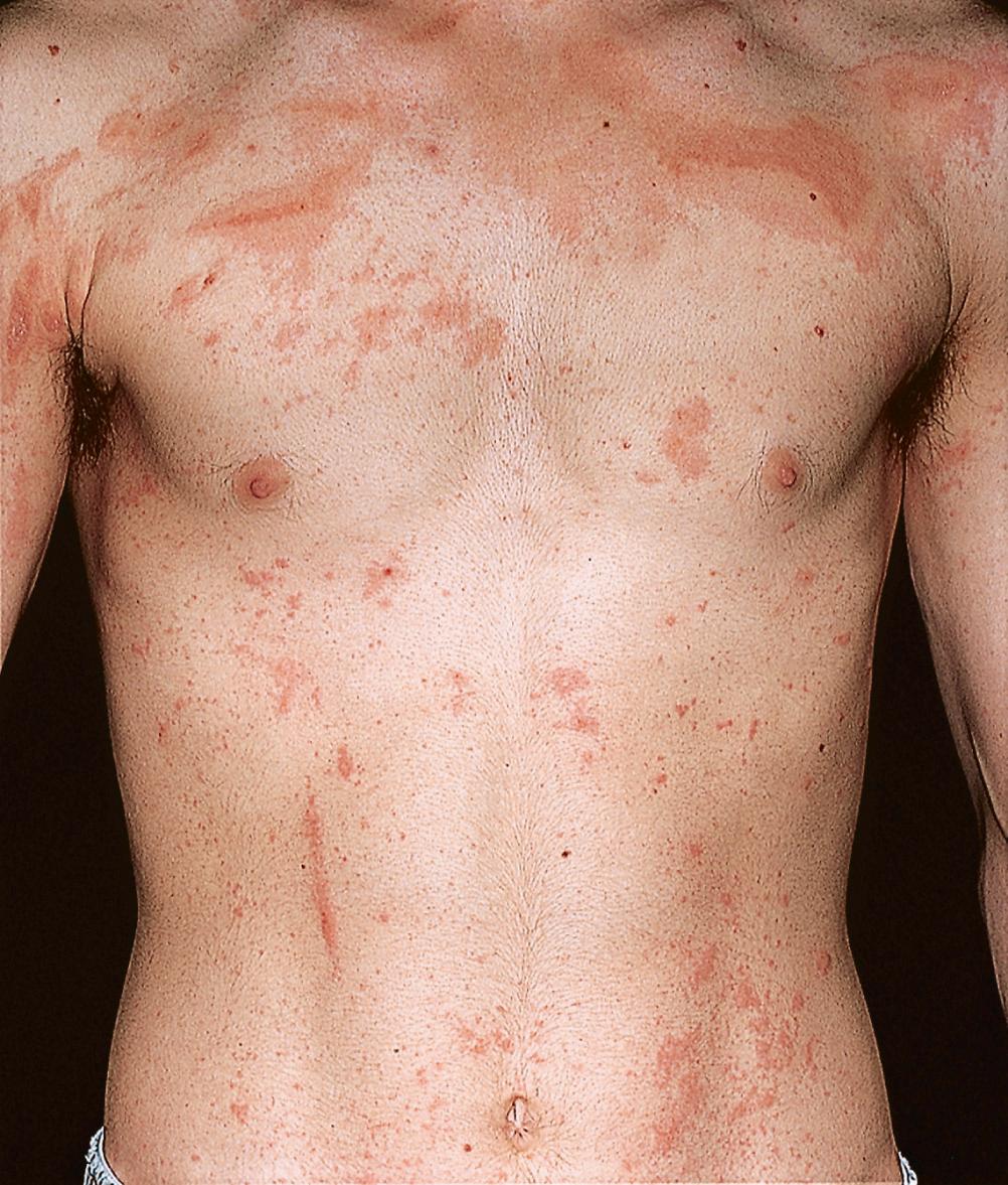 FIG 4.13, Poison ivy dermatitis. Acute inflammation over wide areas. The asymmetric distribution of intense erythema and vesicles suggests the diagnosis of an external insult. Linear lesions are highly characteristic. Inflammation of this intensity usually requires prednisone.