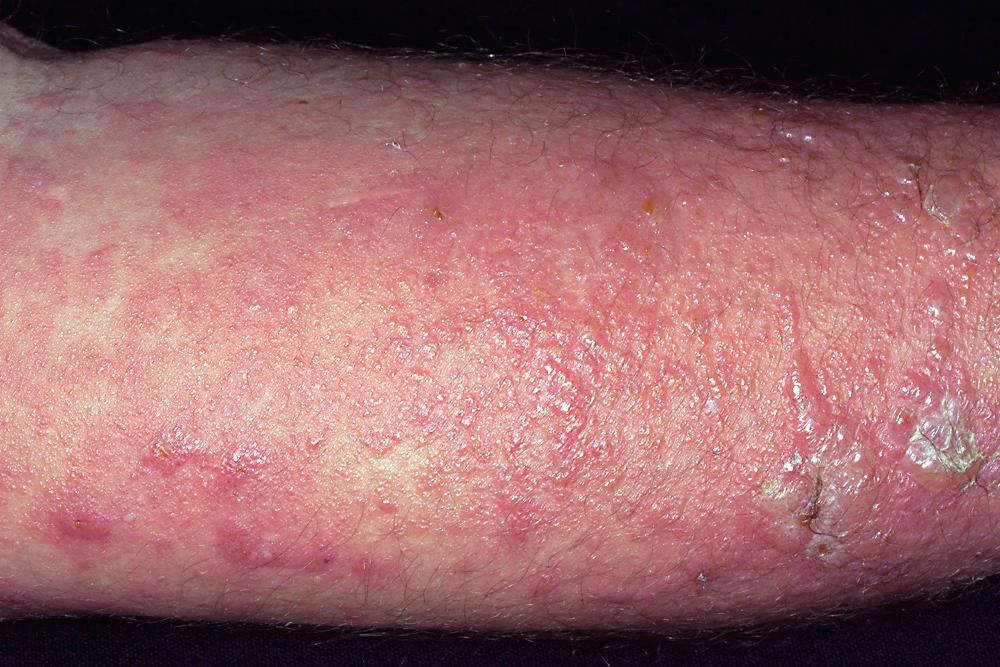 FIG 4.15, Poison ivy dermatitis. An intense eruption with numerous vesicles and confluent blisters. Itching is intolerable. Cold, wet compresses are soothing and therapeutic.