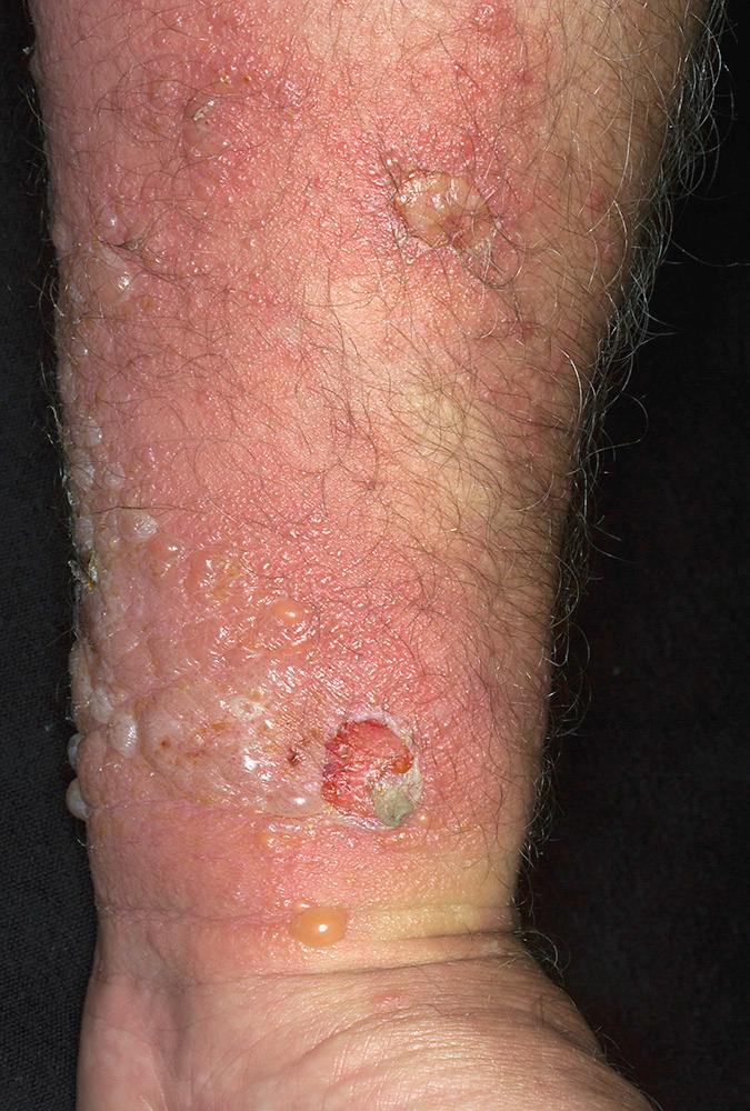 FIG 4.16, Poison ivy dermatitis. Exposure to the plant resulted in intense blistering.