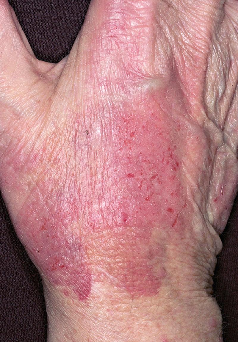 FIG 4.2, Irritant contact dermatitis. Chronic exposure to soap and water has caused subacute eczematous inflammation over the backs of the hands and fingers.