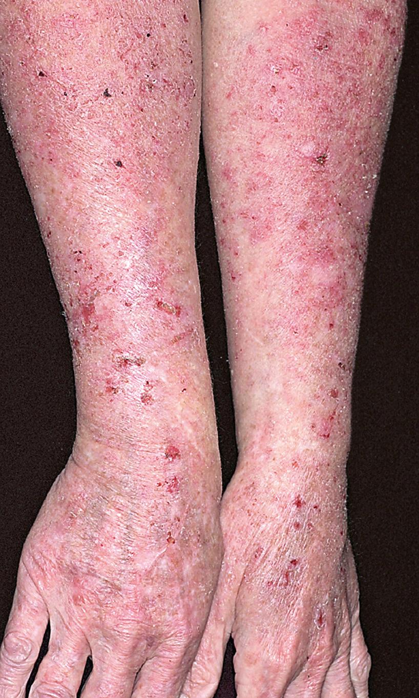 FIG 4.3, Irritant contact dermatitis. A new mother who is exposed to wet diapers followed by frequent washing has developed a diffuse erythema and dry, cracked, fissured skin. Itching is intense.