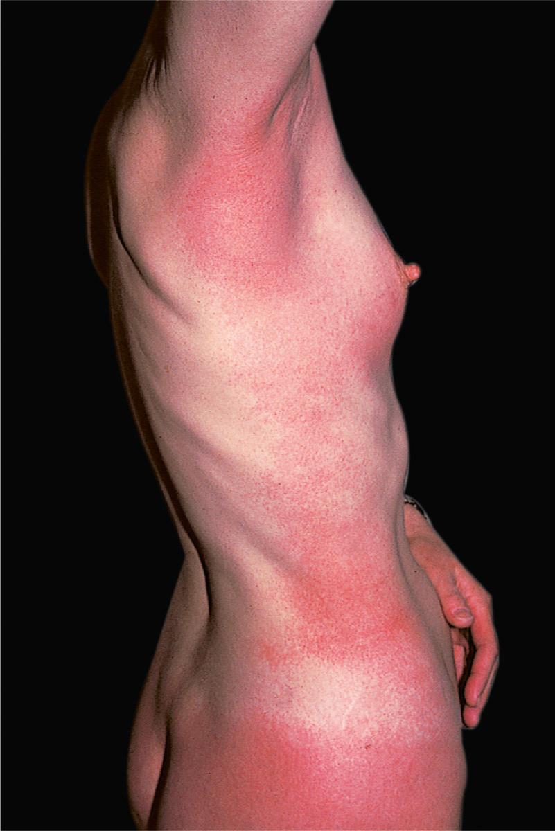 FIG 4.6, Systemically induced allergic contact dermatitis. Diffuse allergic reaction occurring in a patient allergic to poison ivy who has ingested raw cashew nuts, the oil of which cross-reacts with the oleoresin of poison ivy.