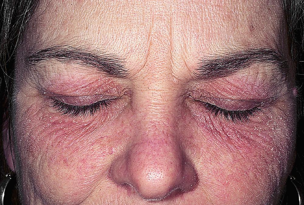 FIG 4.7, Allergic contact dermatitis. Eye cosmetic allergy. Open patch testing with the cosmetic proved the diagnosis. Routine patch testing was positive for fragrance mix.