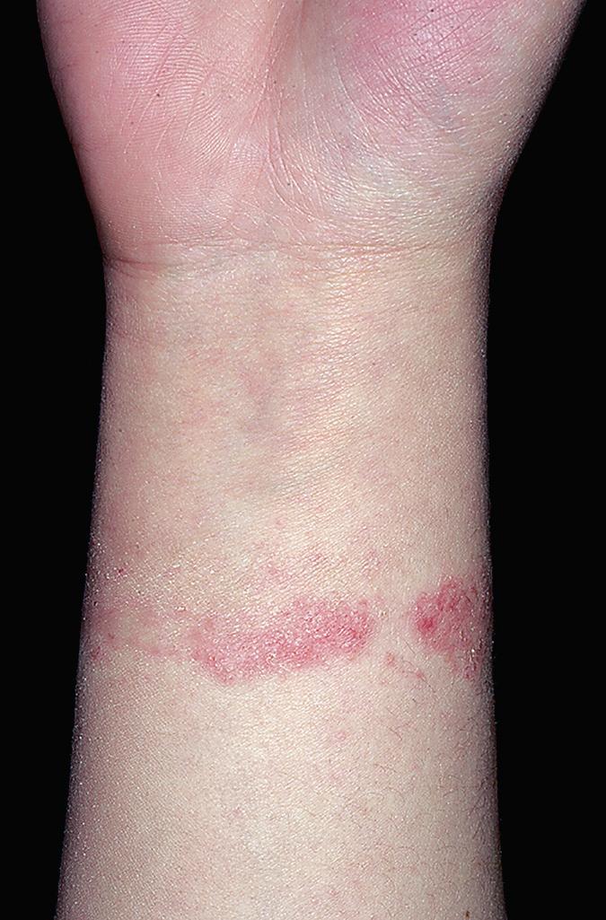 FIG 4.9, Allergic contact dermatitis. Potassium dichromate allergy (leather watchband).