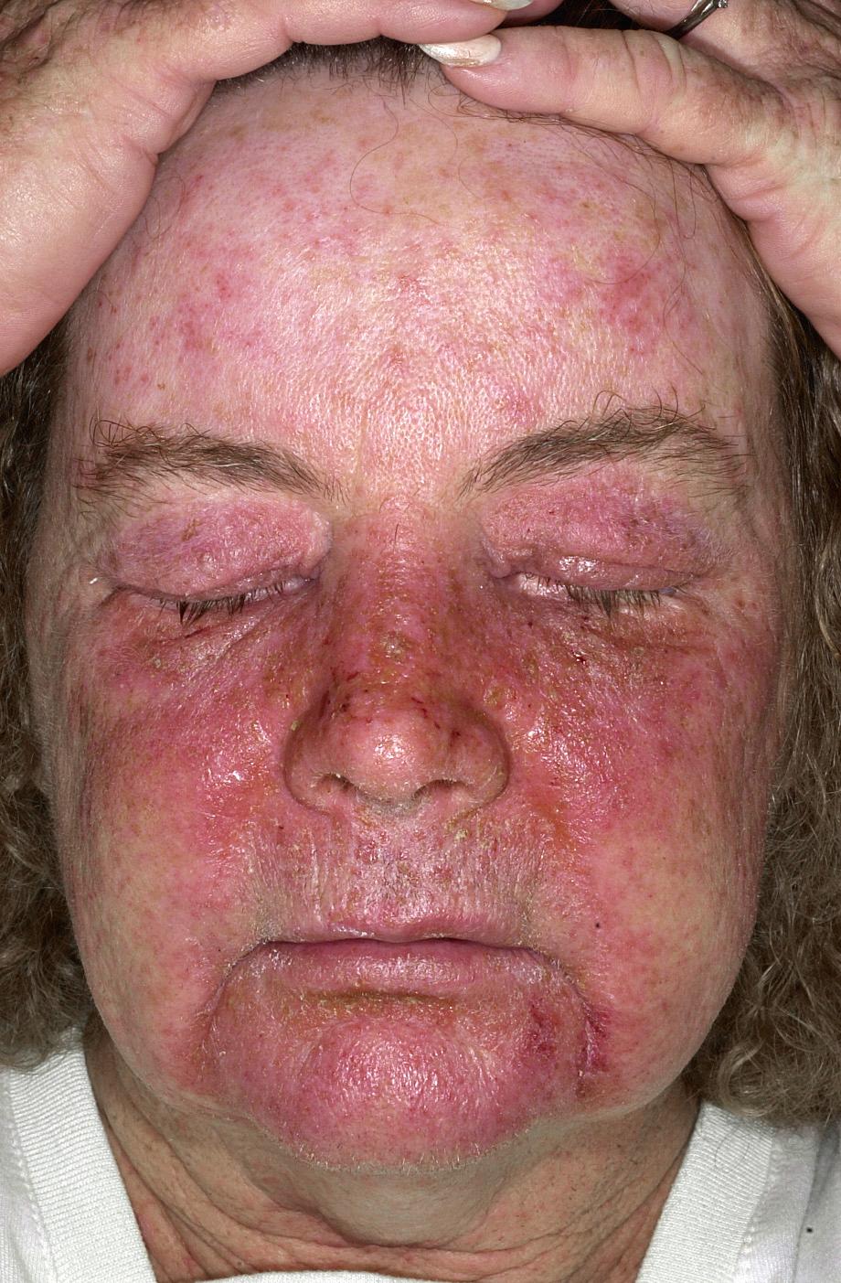 FIG 4.10, Allergic contact dermatitis. Exposure to poison ivy resulted in an intense acute inflammation.