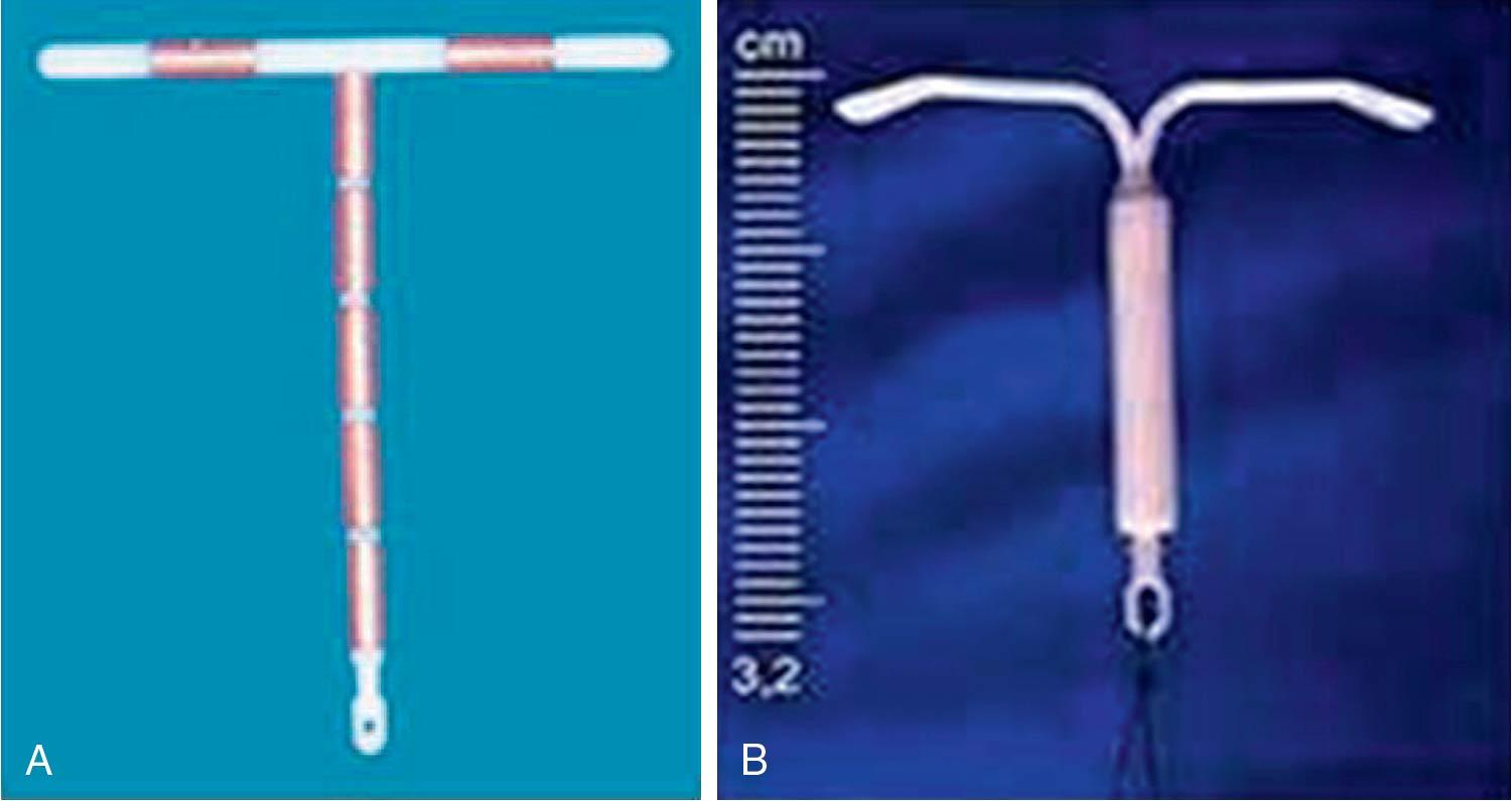 Fig. 13.3, A, Copper T intrauterine device. B, The levonorgestrel intrauterine system (LNG-IUS) Mirena.