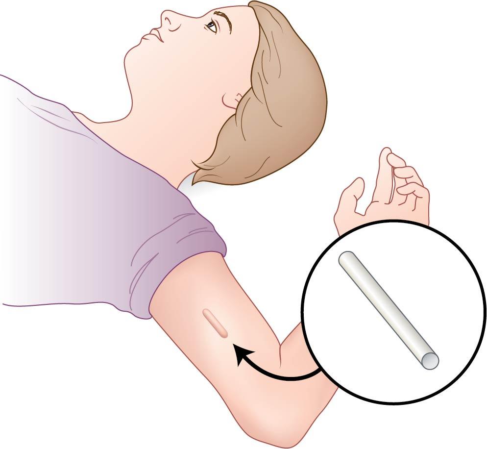 Fig. 13.4, Insertion of a contraceptive implant.