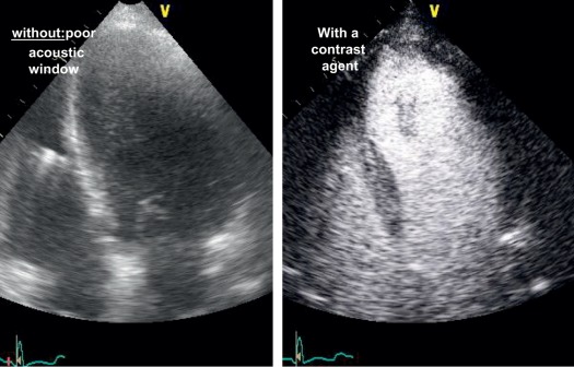 Figure 12.2, Use of an ultrasonic contrast agent to improve the echocardiographic detection of left ventricular endocardial borders. It will help to best quantify the left ventricular geometry and systolic function.