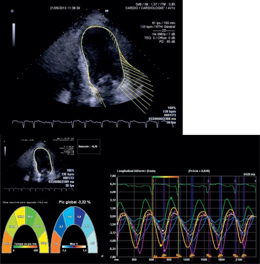 Figure 12.3, Assessment of regional and global left ventricular longitudinal strain.