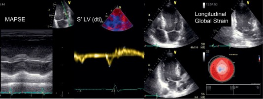 Figure 12.4, Assessment of the longitudinal component of the left ventricular systolic function. MAPSE: mitral annular plan systolic excursion measured by M-mode; S’: pulse tissue Doppler recording systolic and diastolic velocities and s’ is corresponding to the systolic peak velocity of the displacement of the mitral annulus; longitudinal global strain: assessment of the longitudinal deformation of the whole left ventricle using the speckle tracking technique.