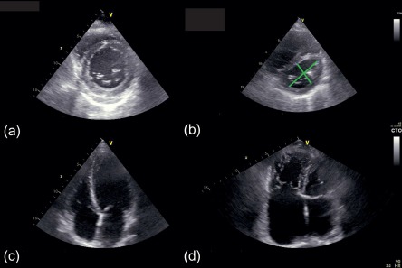 Figure 12.5, Right ventricular shape in normal and pathological condition. Under normal loading conditions, the right ventricle (RV) appears crescent-shaped in cross section (a) and triangular-shaped in the sagittal plane (c), and the interventricular septum is concave toward the LV in both systole and diastole. In condition of RV pressure and volume overload, left deviation of the interventricular septum may occur, which causes a reduction of the LV cavity and LV function impairment (b and d). In this patient, an end-dyastolic LV sphericity index (LV major axis/LV minor axis) = 2 (b), identifies a severe alteration of LV morphology due to severe pulmonary hypertension.