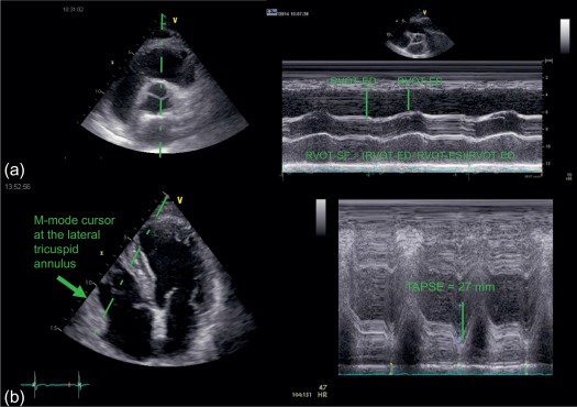 Figure 12.6, Right ventricular outflow tract shortening fraction and tricuspid annular plane systolic excursion measurement. ED, end-diastole ES; end-systole; right ventricular outflow tract (RVOT); TAPSE, tricuspid annular plane systolic excursion.