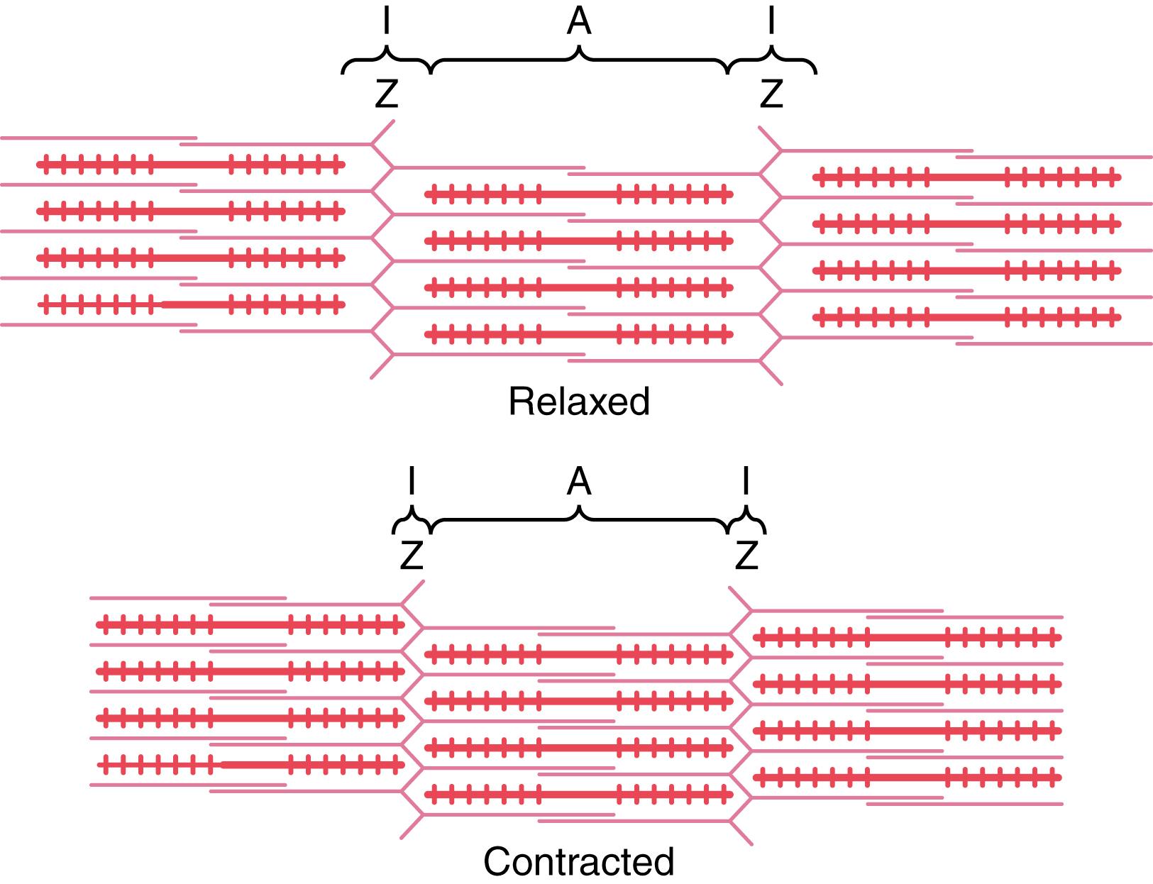 Figure 6-5, Relaxed and contracted states of a myofibril showing ( top ) sliding of the actin filaments ( pink ) into the spaces between the myosin filaments ( red ) and ( bottom ) pulling of the Z membranes toward each other.