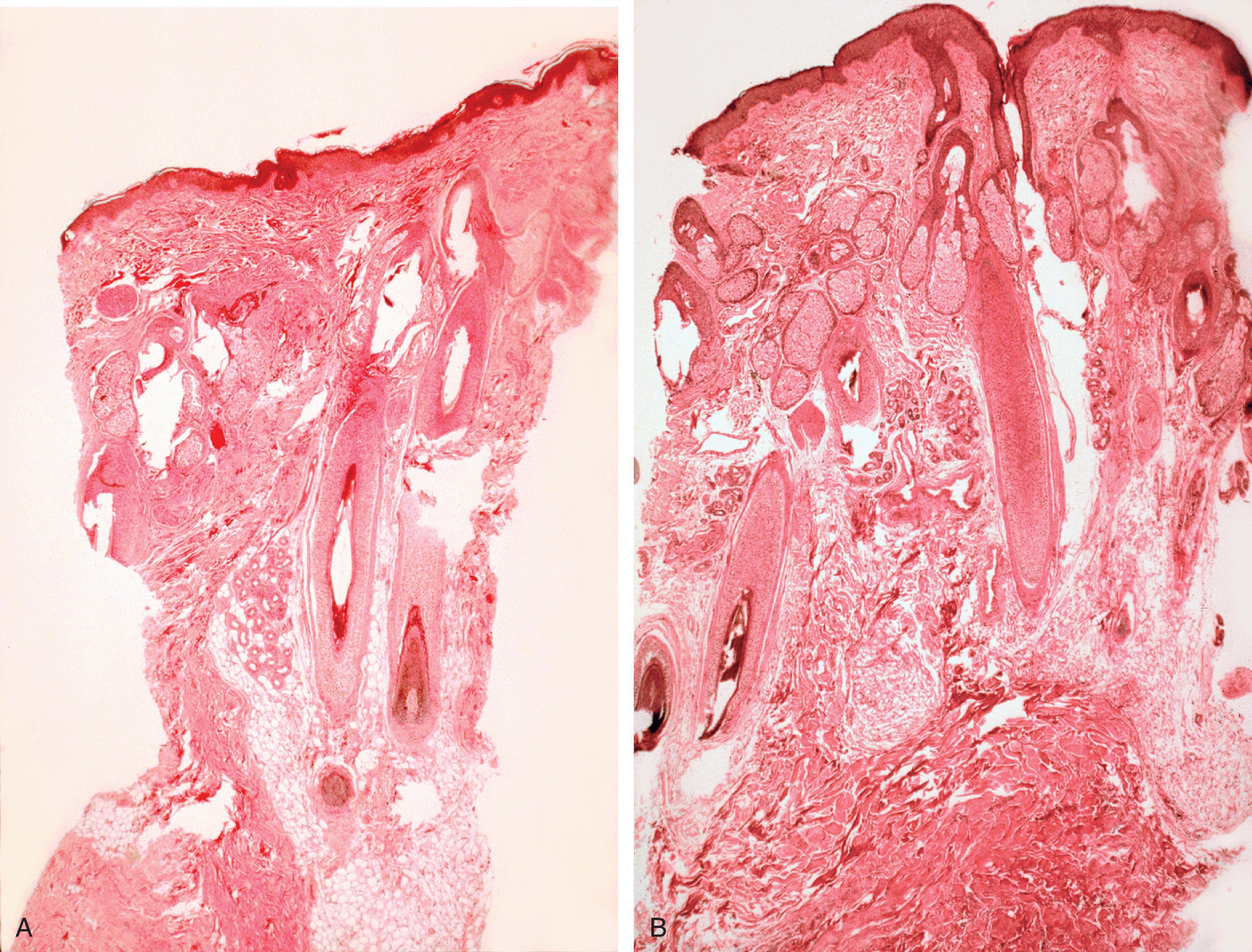 FIG. 25.1, A , Biopsy specimen of no expanded skin. B , Biopsy specimen of expanded skin in same area. Note that the thickness of the epidermis is maintained.