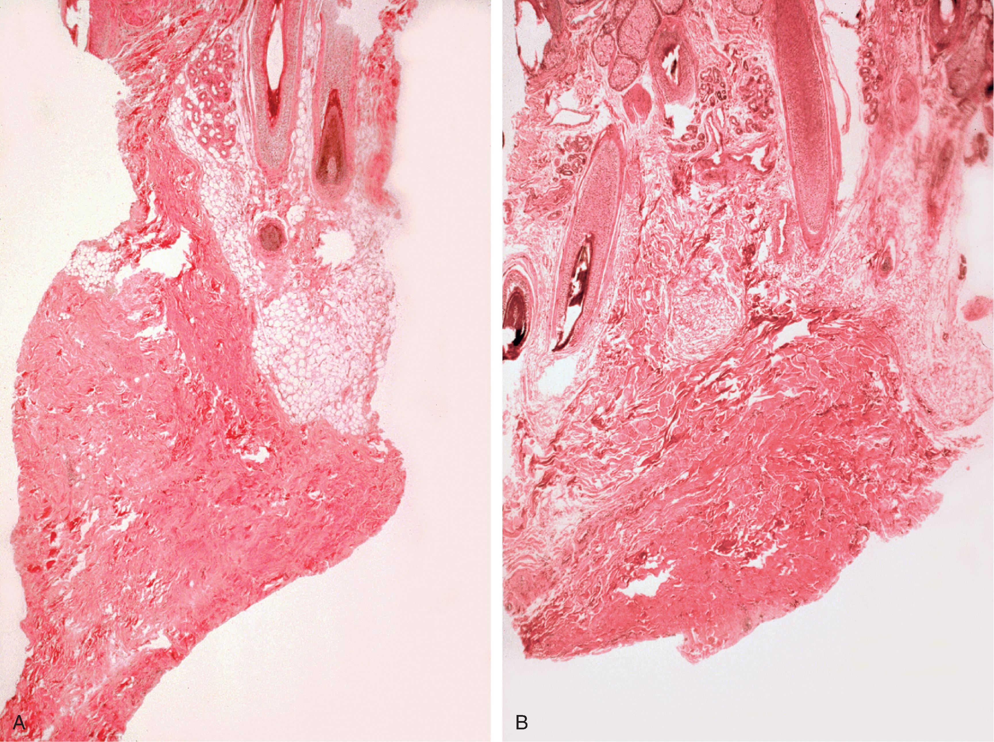 FIG. 25.2, A , Biopsy specimen of no expanded skin. Note presence of numerous fat cells. B , Biopsy specimen of expanded skin in same area. Note absence of fat cells.