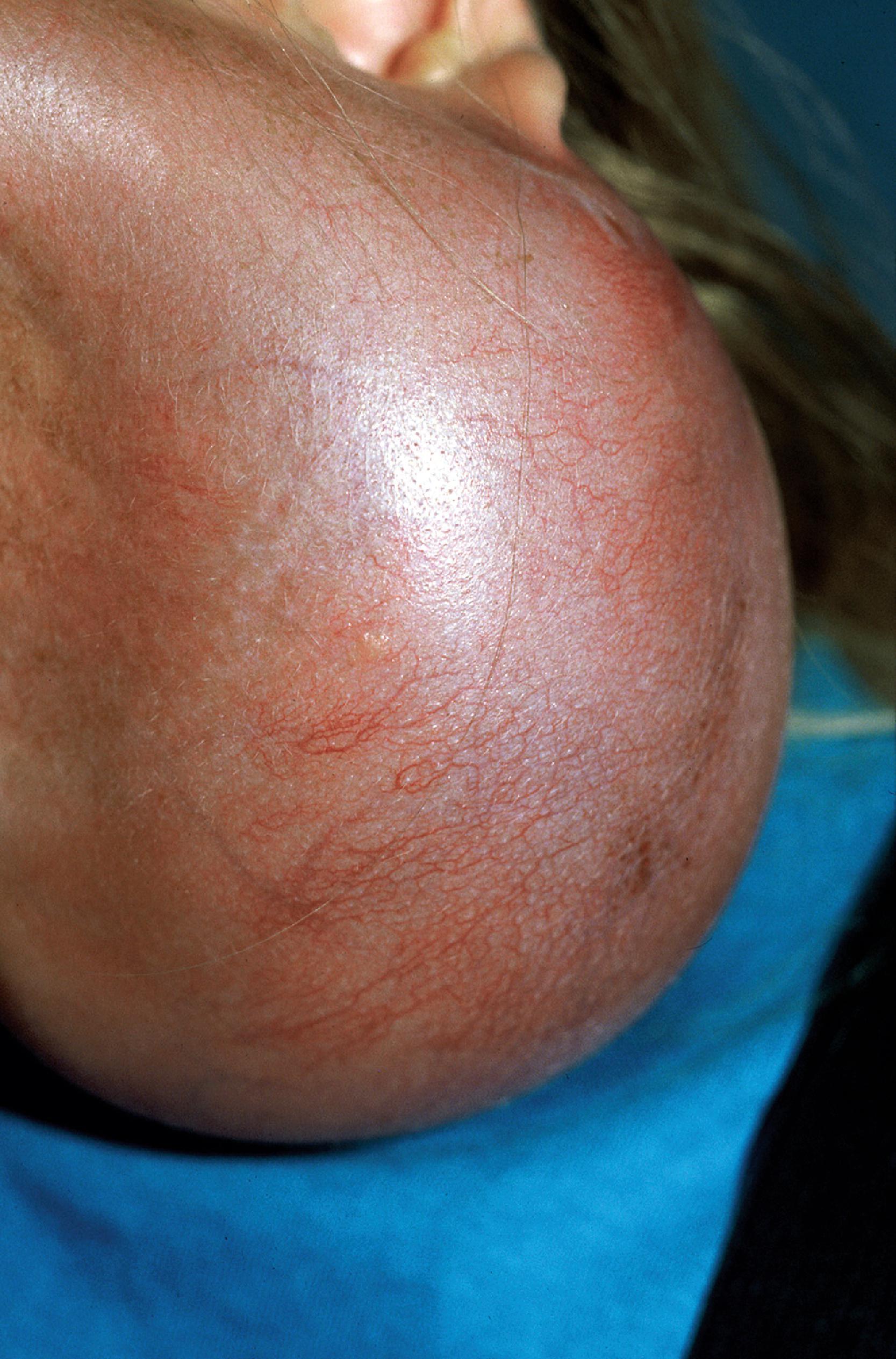 FIG. 25.3, Expanded skin demonstrating vascular proliferation.