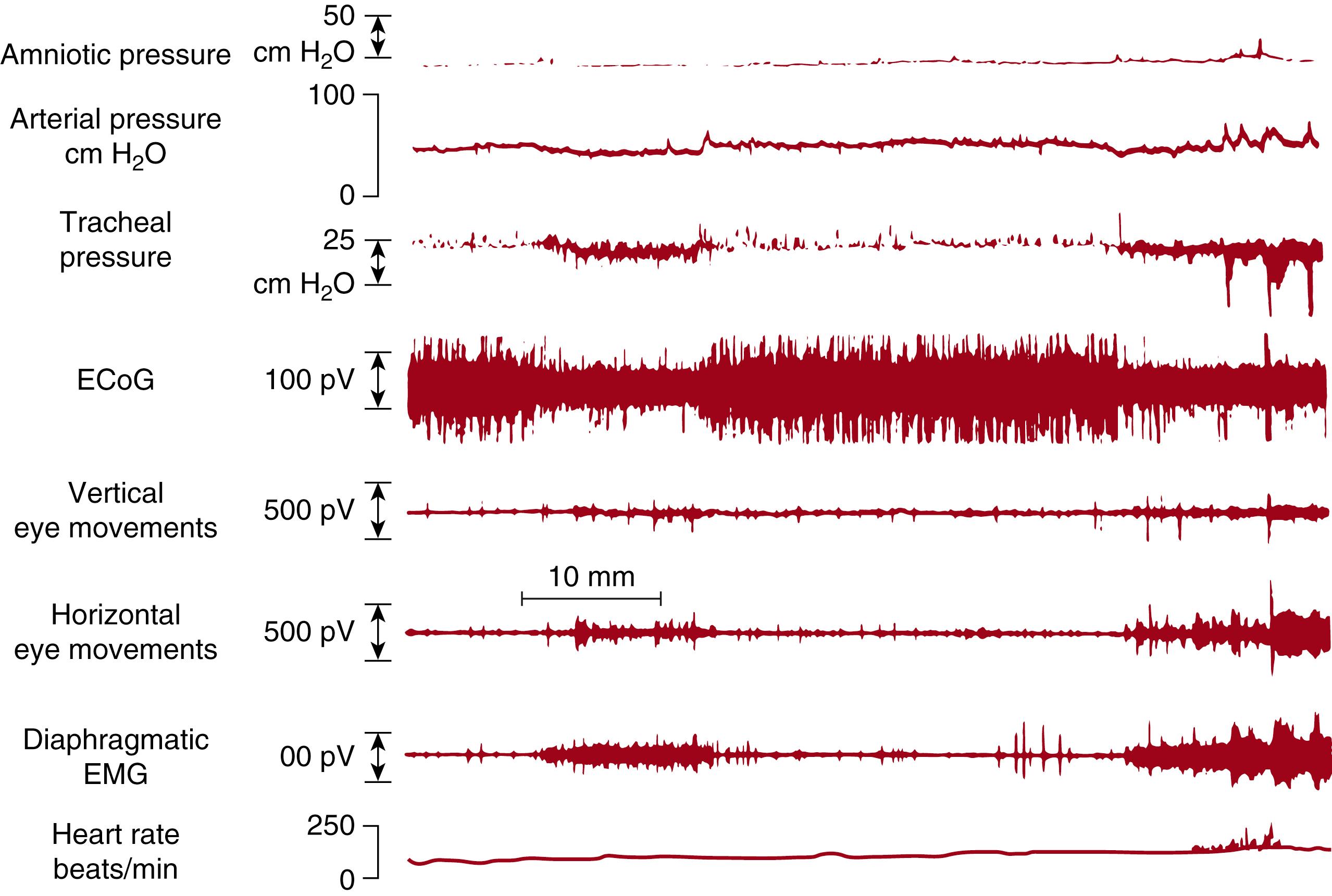 Fig. 66.1, Fetal breathing in a fetal lamb at 134 days’ gestation. Note that the deflections in tracheal pressure and diaphragmatic activity occur during periods of rapid eye movement sleep in low-voltage electrocortical activity (ECoG) only. In high-voltage electrocortical activity (quiet sleep), breathing is absent. EMG, Electromyogram.