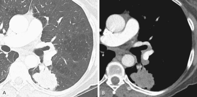 Fig. 21.1, Squamous cell carcinoma of the lung in a 71-year-old woman. Axial computed tomography image with contrast material in (A) lung windows and (B) soft-tissue windows shows a sizeable, irregular, spiculated, heterogeneously enhancing mass in the left lower lobe in a patient with severe smoking-related emphysema. The large size, irregular borders, and enhancement are all characteristics associated with malignancy.