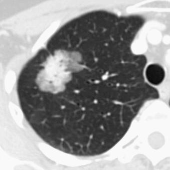 Fig. 21.2, Nonsmall cell lung cancer in a nonsmoking 63-year-old woman. Axial computed tomography image with contrast material in lung windows shows a large multilobulated right upper lobe lesion having both solid and ground-glass attenuation. The large solid component is suspicious for a more aggressive lesion. Examination of the biopsy specimen indicated invasive adenocarcinoma.