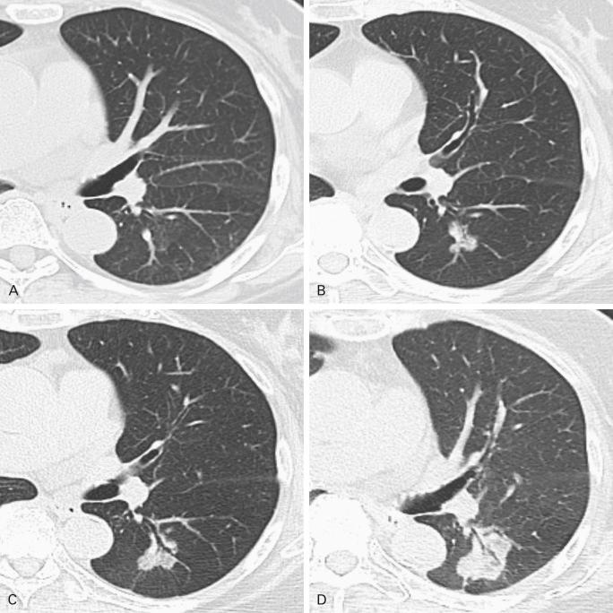 Fig. 21.3, Ground-glass lesion progressing over time in a 73-year-old woman. Axial computed tomography images in lung windows over an 8-year period. (A) Baseline image shows a nearly imperceptible ground-glass opacity in the superior segment of the left lower lobe; (B) after approximately 3 years, a small lobulated ground-glass opacity is visible in this region; (C) after another 3 years, the lesion continues to enlarge and demonstrates an air bronchogram; and (D) at the last time period, 8 years after the original presentation, the tumor has progressed in both size and density and is compatible with a primary lung adenocarcinoma. It was not resected because of multifocal adenocarcinomas in this patient.