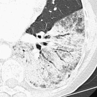 Fig. 21.4, Nonsmall cell lung cancer in a 71-year-old woman. This heterogeneous consolidation filling and expanding the left lower lobe on axial computed tomography in lung windows is proven by examination of a biopsy specimen to be a well-differentiated mucinous adenocarcinoma with bronchoalveolar features.