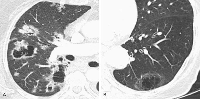 Fig. 21.5, Adenocarcinomas with central lucencies. (A) Axial computed tomography (CT) image in lung windows demonstrates multifocal lung opacities, some with pseudocavitation, in this 75-year-old man with primary lung adenocarcinoma having both mucinous and nonmucinous components, and (B) axial CT image in lung windows shows adenocarcinoma developing in the periphery of a preexisting cluster of emphysematous spaces in a 71-year-old woman.