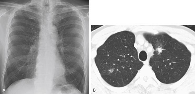 Fig. 21.6, Nonsmall cell lung cancer in an 85-year-old man. (A) Posteroanterior chest radiograph shows hyperinflated lungs compatible with chronic obstructive pulmonary disease. A small opacity is seen partially overlying the right posterior sixth rib. Hazy opacity also appears along the left paratracheal region just above the aortic arch. This example demonstrates the difficulty of visualizing subsolid lung lesions, the blind spots associated with the mediastinum and overlapping bone structures, and satisfaction of search limitations. (B) Axial computed tomography image in lung windows demonstrates bilateral lung tumors, which were proven by examination of a biopsy specimen to be synchronous adenocarcinomas.