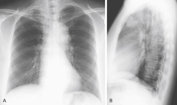 Fig. 21.8, Adenocarcinoma in a 69-year-old woman. (A) Posteroanterior radiograph of the chest has slightly increased density in the region of the aortic arch and aorticopulmonary window. (B) The lesion is much easier to visualize on the lateral projection, in which a multilobulated tumor is seen anteriorly in the retrosternal space.