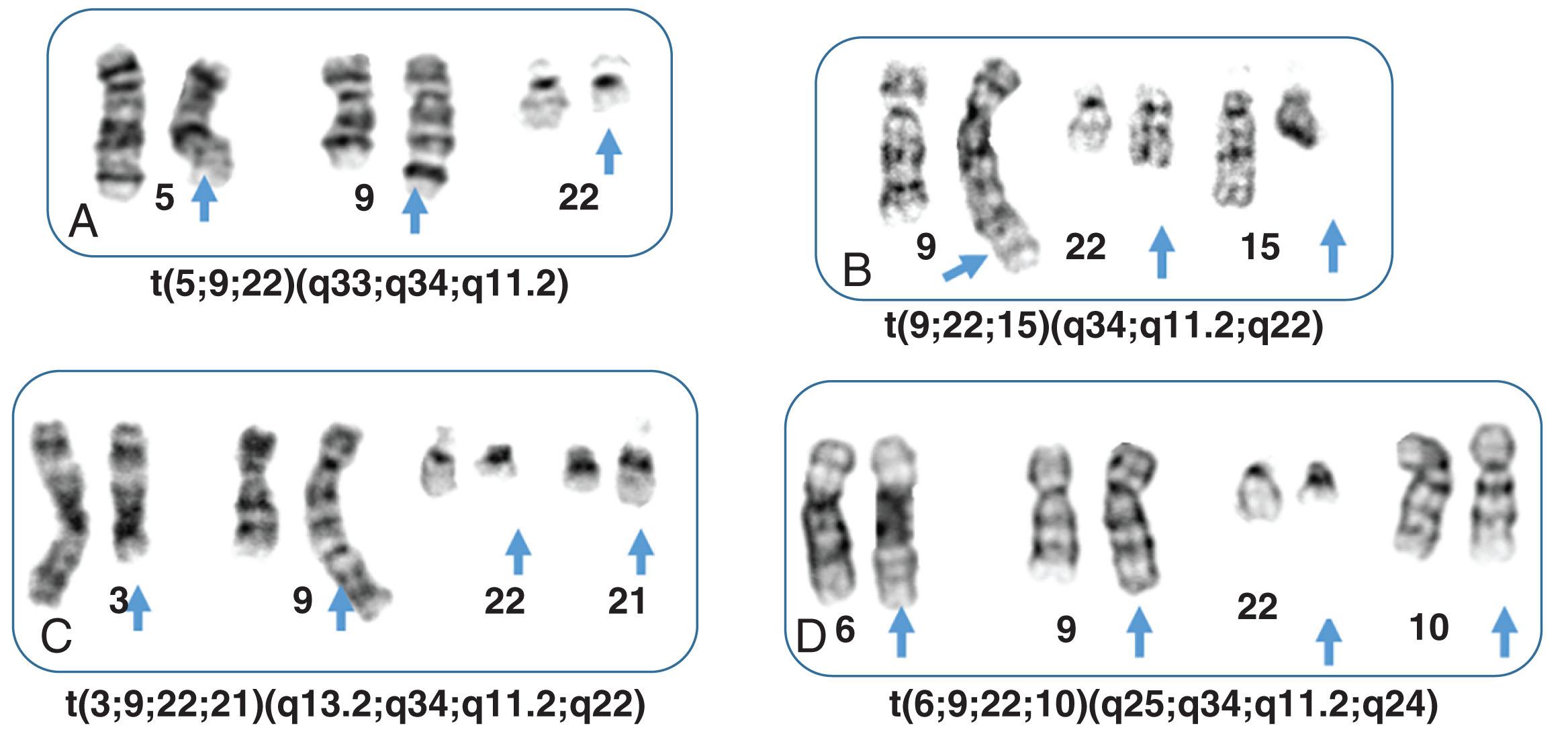 Figure 57.11, PARTIAL KARYOTYPES FROM 4 PATIENTS SHOWING 3- AND 4-WAY Ph TRANSLOCATIONS IN CHRONIC MYELOID LEUKEMIA.