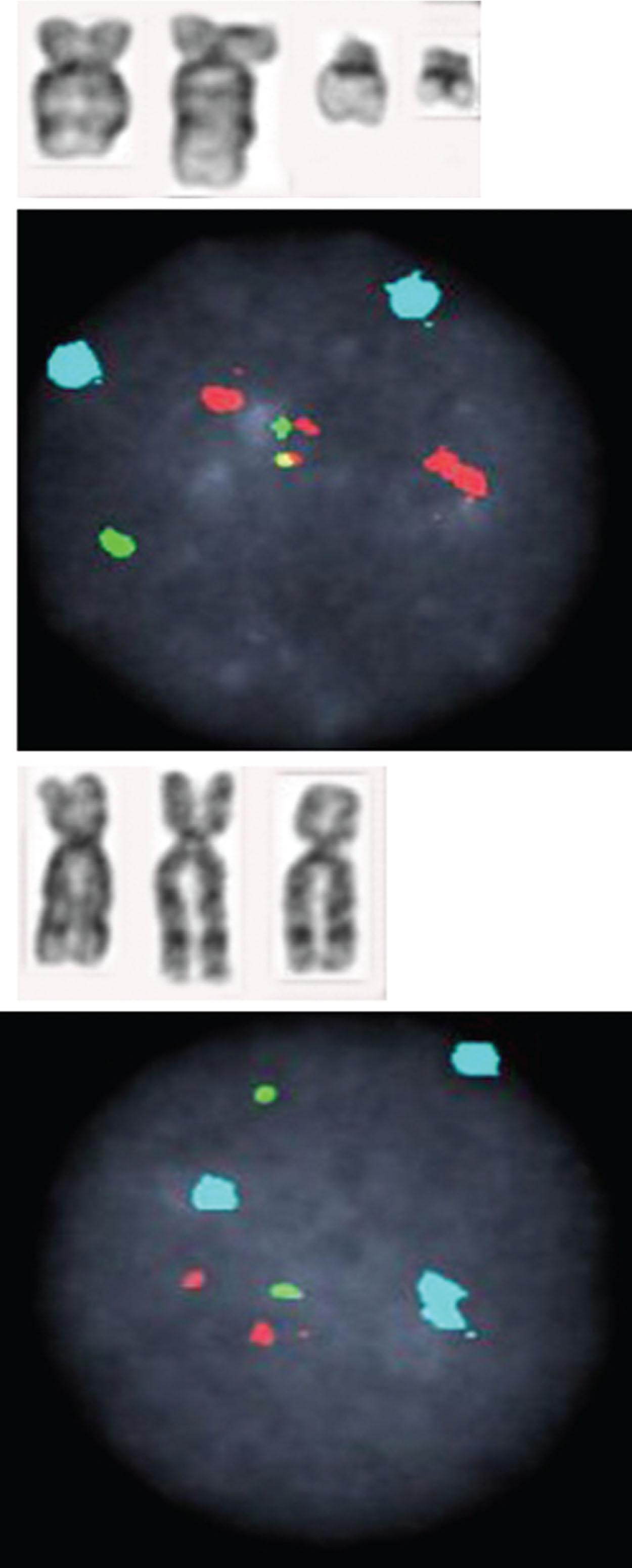 Figure 57.15, TWO DIFFERENT CELL POPULATIONS FROM A PATIENT TREATED WITH IMATINIB.