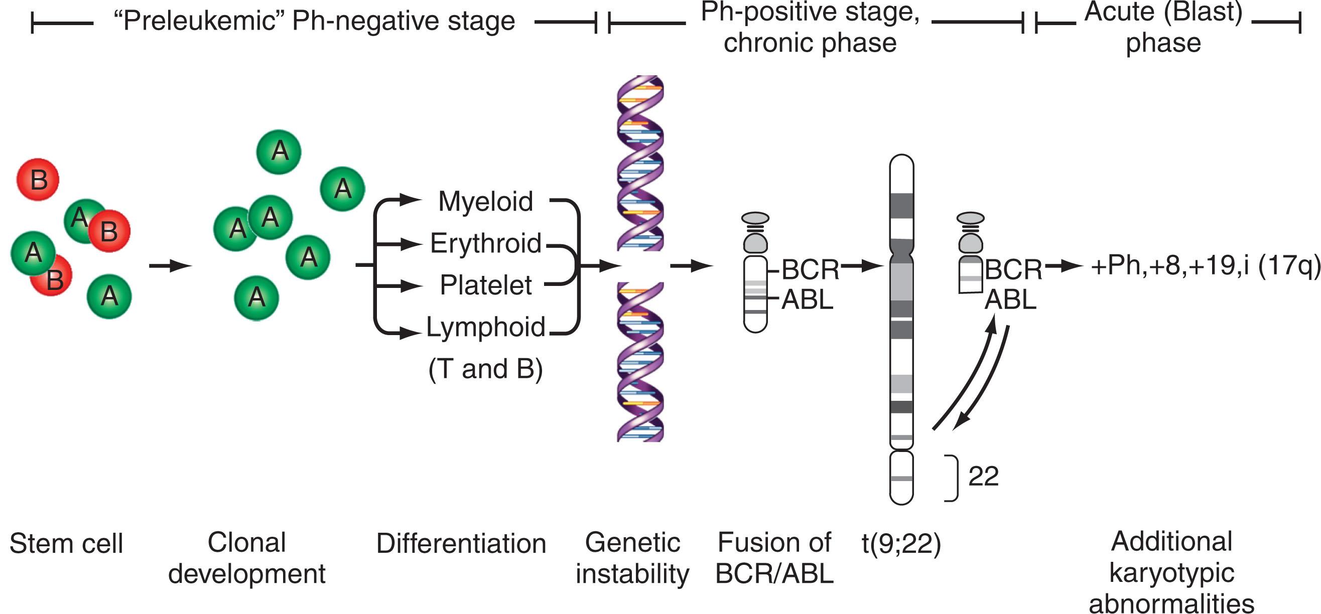 Figure 57.16, HYPOTHETICAL MODEL OF MULTISTEP PATHOGENESIS OF Ph-POSITIVE CHRONIC MYELOGENOUS LEUKEMIA.