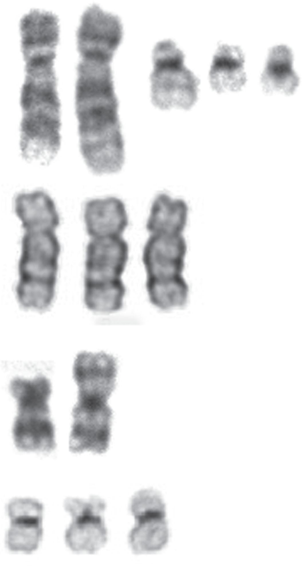 Figure 57.17, THE FOUR MOST FREQUENT ABNORMALITIES ASSOCIATED WITH THE BLAST CRISIS OF CHRONIC MYELOGENOUS LEUKEMIA.