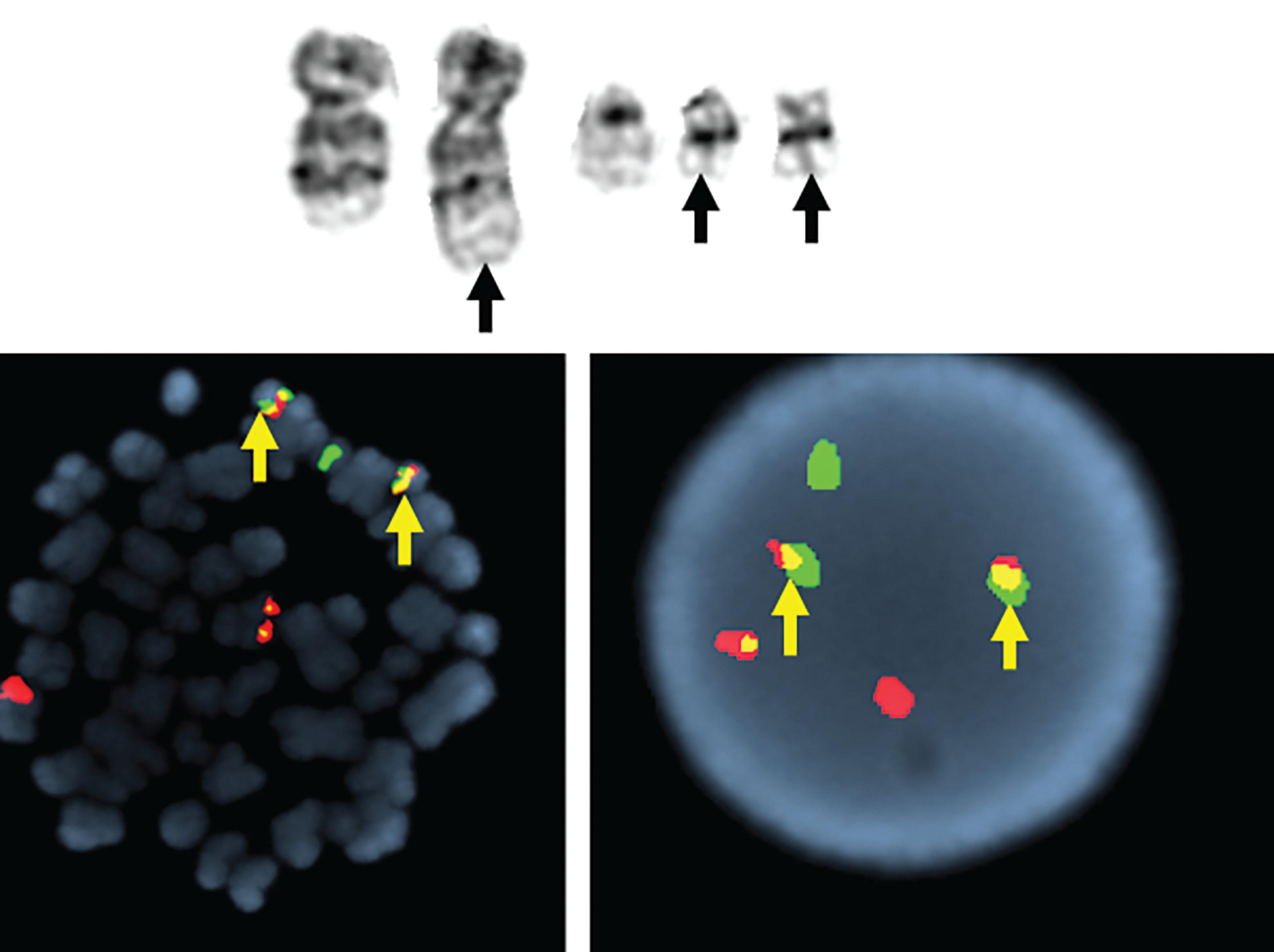 Figure 57.18, BLAST CRISIS OF CHRONIC MYELOID LEUKEMIA.