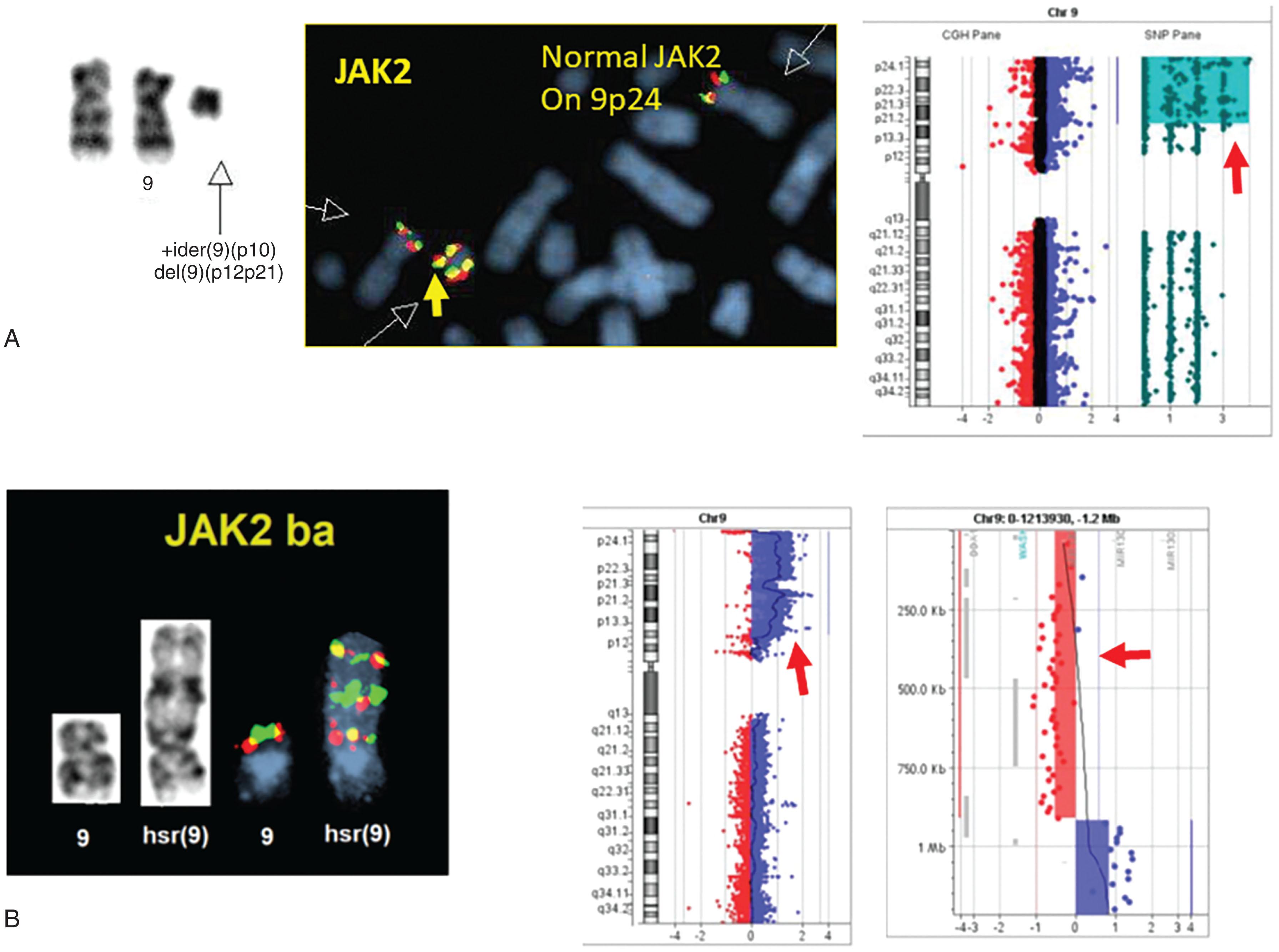 Figure 57.20, TWO DIFFERENT TYPES OF 9P CHROMOSOMAL ABNORMALITIES AND SUBSEQUENT JAK2 COPY NUMBER ALTERATIONS IN Ph-NEGATIVE MYELOPROLIFERATIVE NEOPLASM.