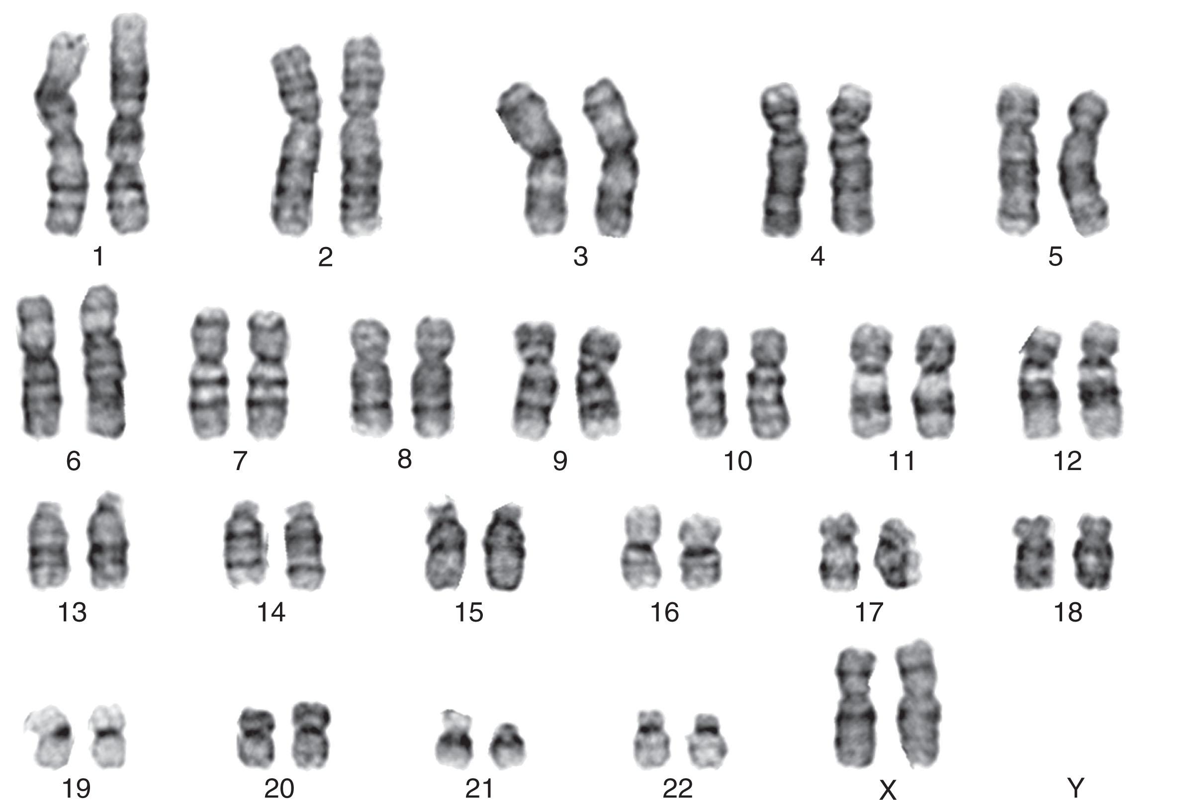 Figure 57.2, NORMAL ARRANGEMENT OF CHROMOSOMES IN A KARYOTYPE FROM A NORMAL BONE MARROW METAPHASE SHOWING A SLIGHTLY FUZZY MORPHOLOGY COMPARED WITH A NORMAL KARYOTYPE OBTAINED FROM PHYTOHEMAGGLUTININ-STIMULATED PERIPHERAL BLOOD CELLS.