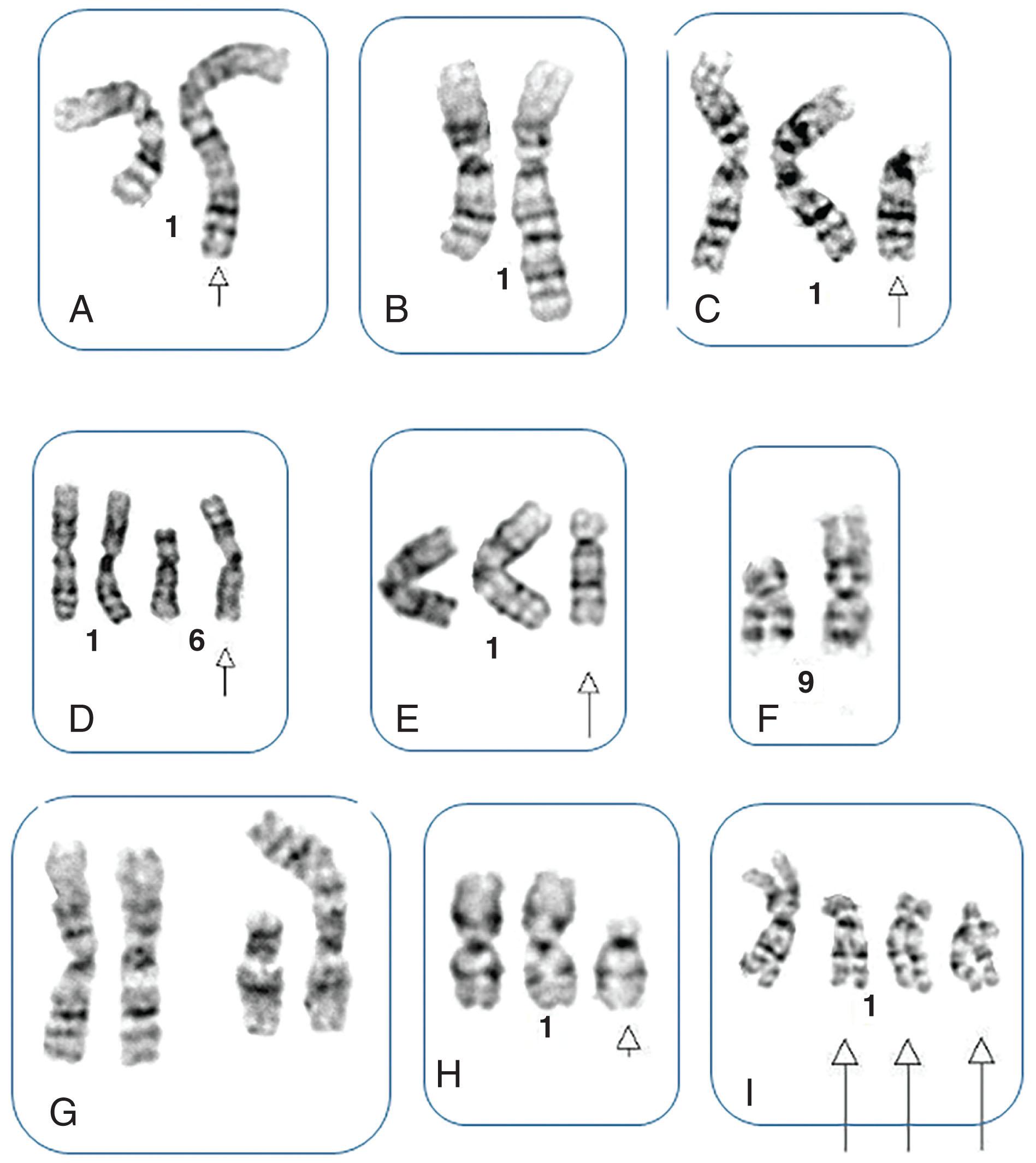 Figure 57.21, NINE TYPES OF 1q GAINS IN PATIENTS WITH Ph-NEGATIVE MYELOPROLIFERATIVE NEOPLASM WHO EITHER HAD +1q AT DIAGNOSIS OR PROGRESSED TO MYELOFIBROSIS AND DEVELOPED +1q.