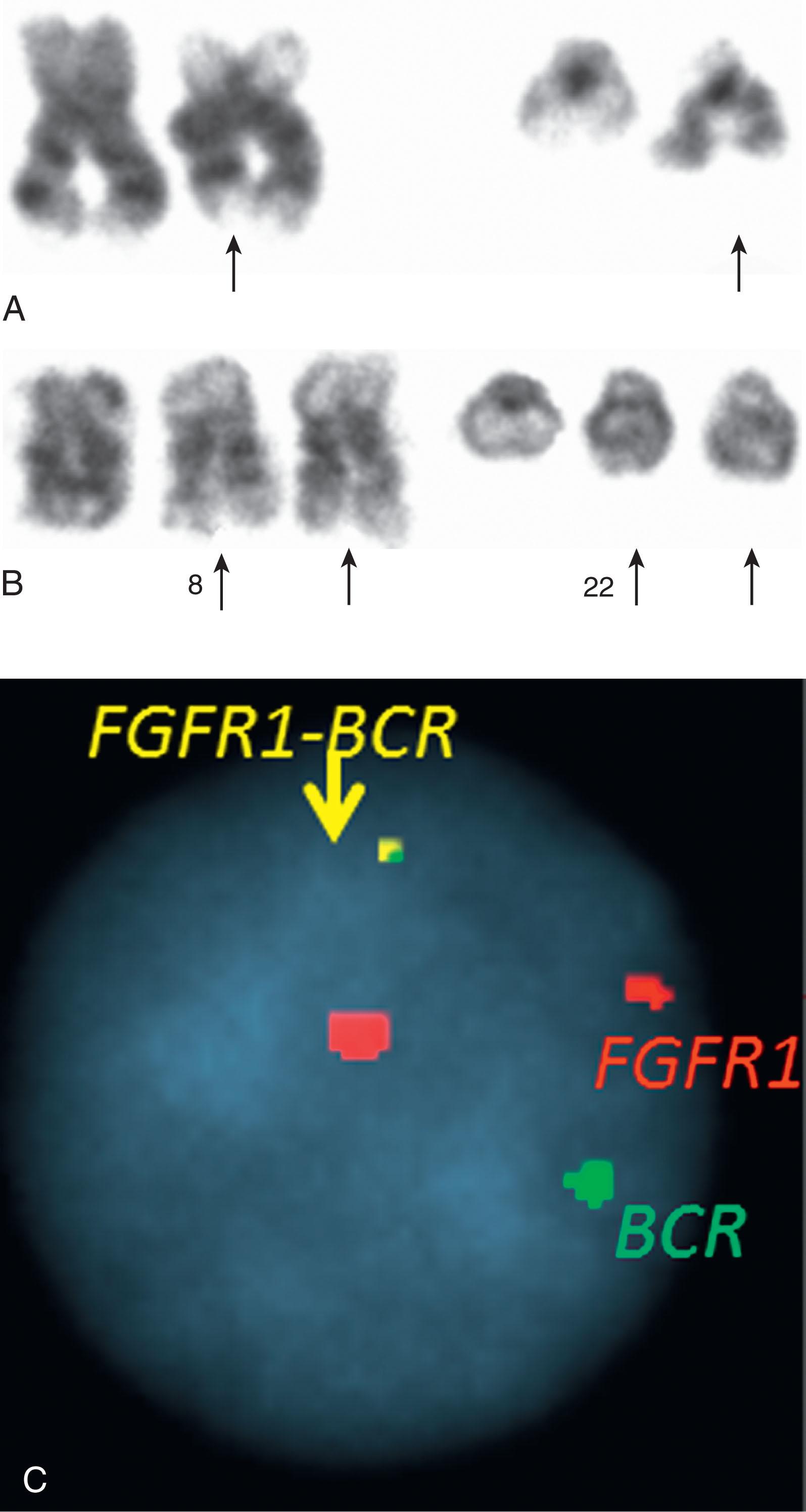 Figure 57.22, (A) A partial karyotype from a patient diagnosed with Ph-negative myeloproliferative neoplasm showing t(8;22)(p11;q11.2). (B) Six months later the patient developed hyperdiploid karyotype, acute lymphoblastic leukemia, and two copies of t(8;22). (C) Interphase FISH confirmed a FGFR1 (red)- BCR (green) fusion (yellow) .