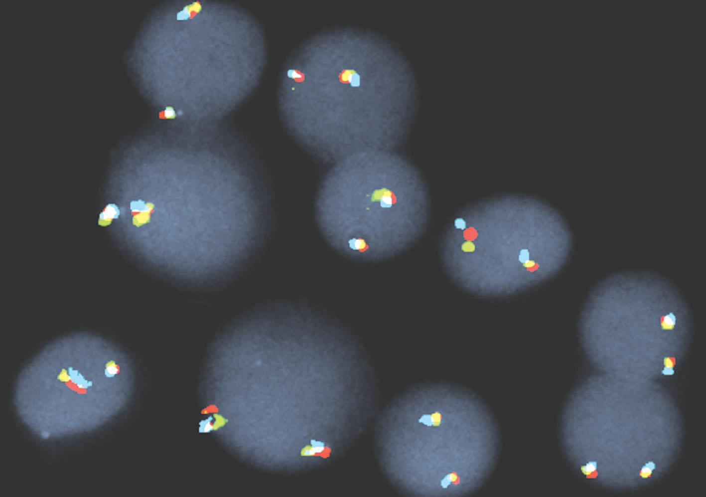 Figure 57.23, BONE MARROW INTERPHASE NUCLEI AFTER FLUORESCENCE IN SITU HYBRIDIZATION STUDIES USING TRICOLOR PROBE FOR CHROMOSOME 4, BAND REGION q12.