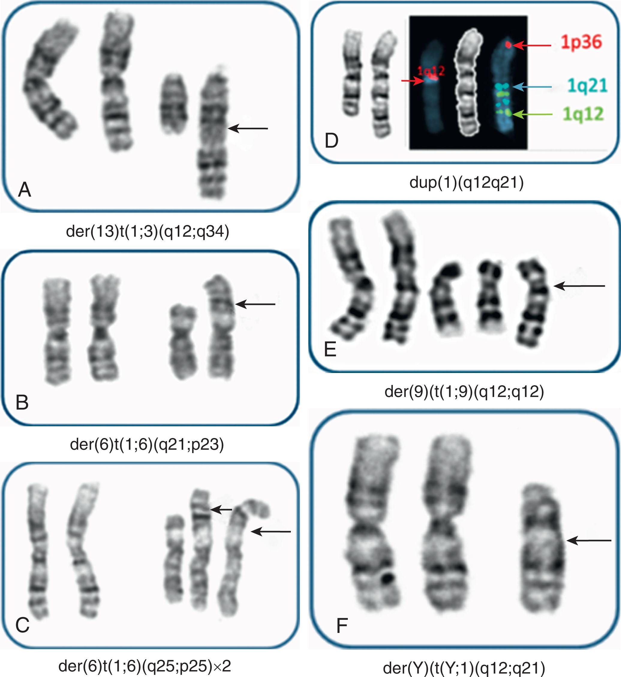 Figure 57.27, GAIN OF LONG ARMS OF CHROMOSOME 1 IN MYELODYSPLASTIC SYNDROME.