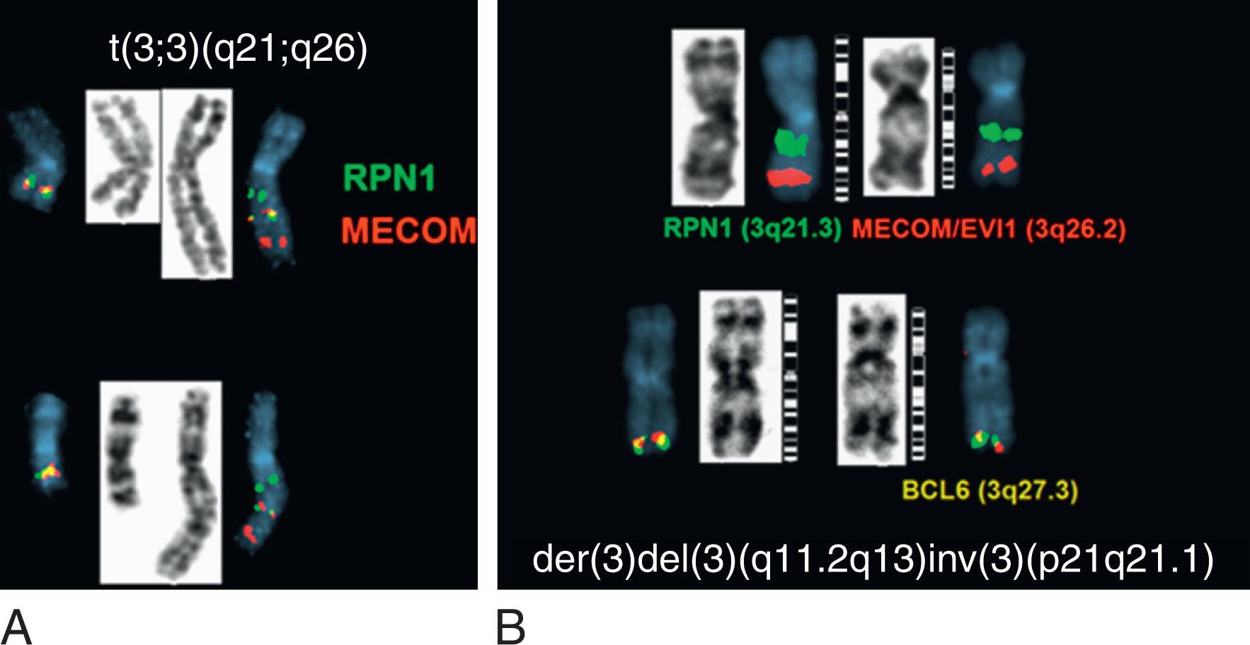 Figure 57.28, CHROMOSOME 3 ABNORMALITIES IN MYELODYSPLASTIC SYNDROME.