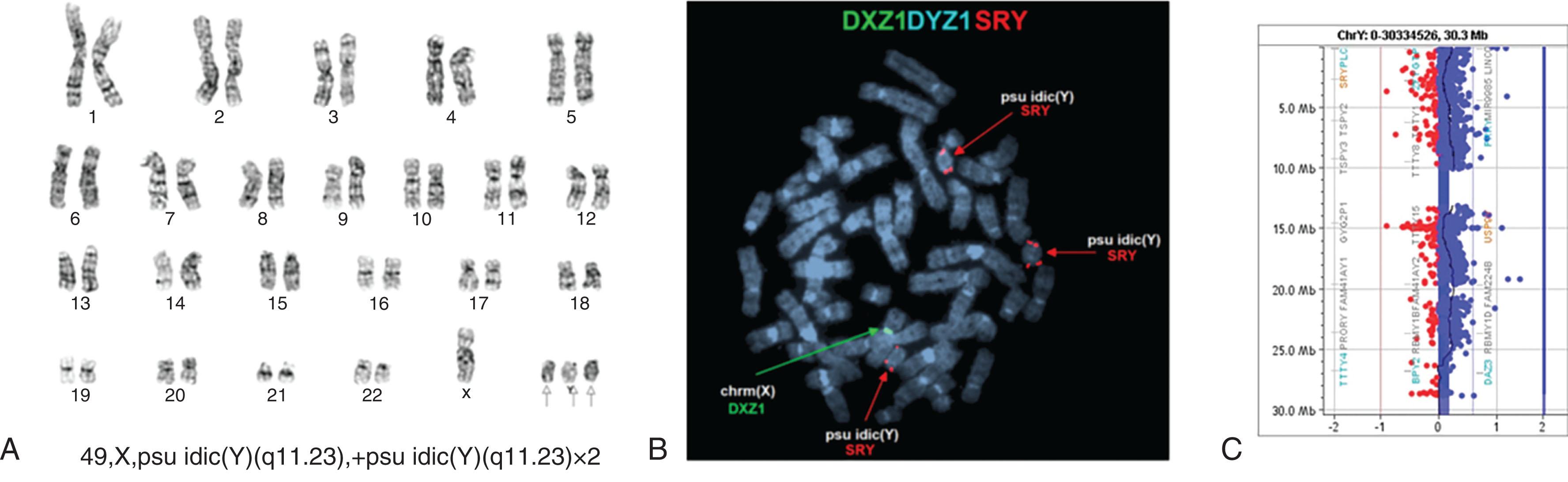 Figure 57.29, PSEUDO ISODICENTRIC Y CHROMOSOME IN MYELODYSPLASTIC SYNDROME.