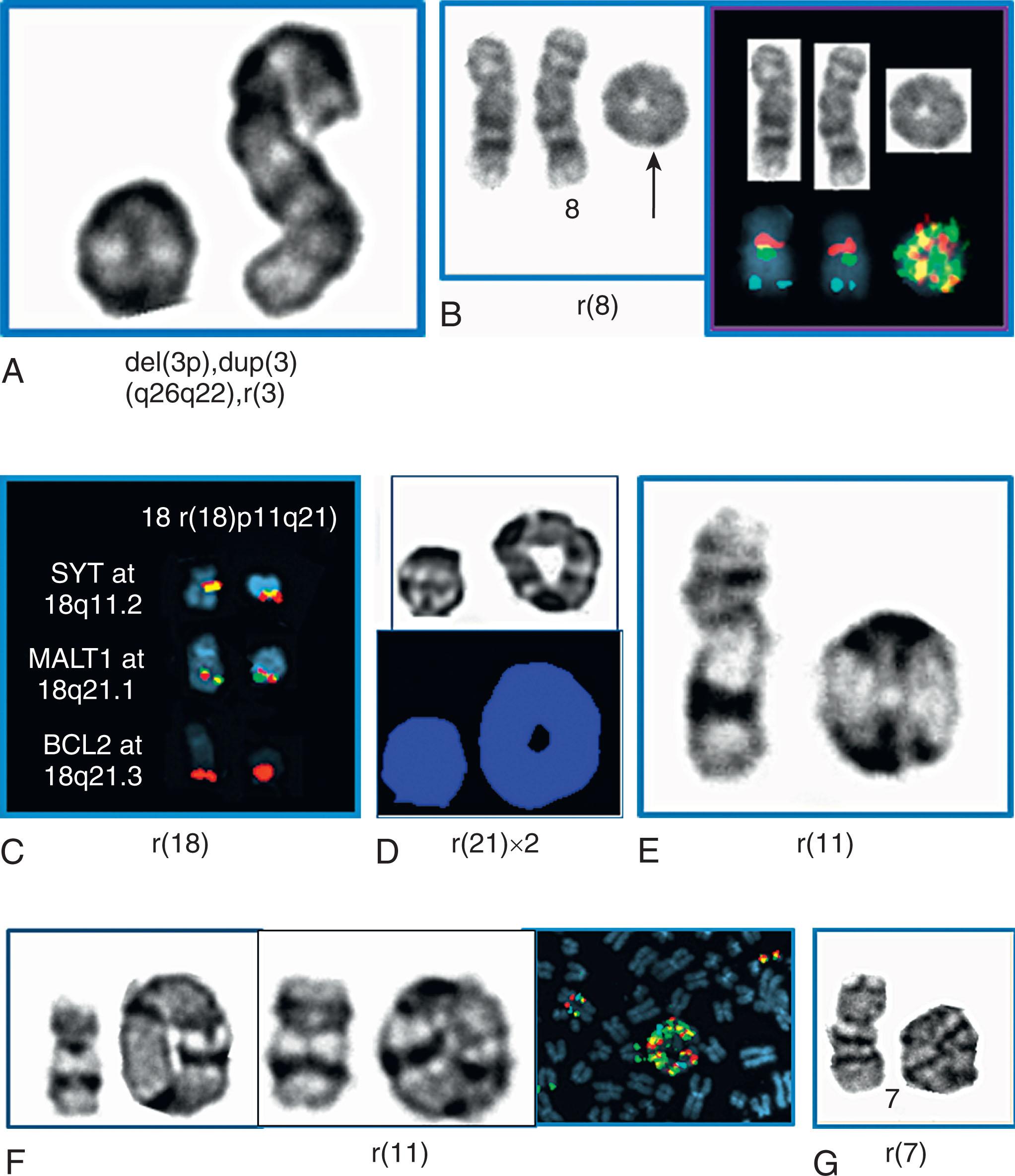 Figure 57.30, RING CHROMOSOMES IN MYELODYSPLASTIC SYNDROME AND OTHER HEMATOLOGIC MALIGNANCIES.