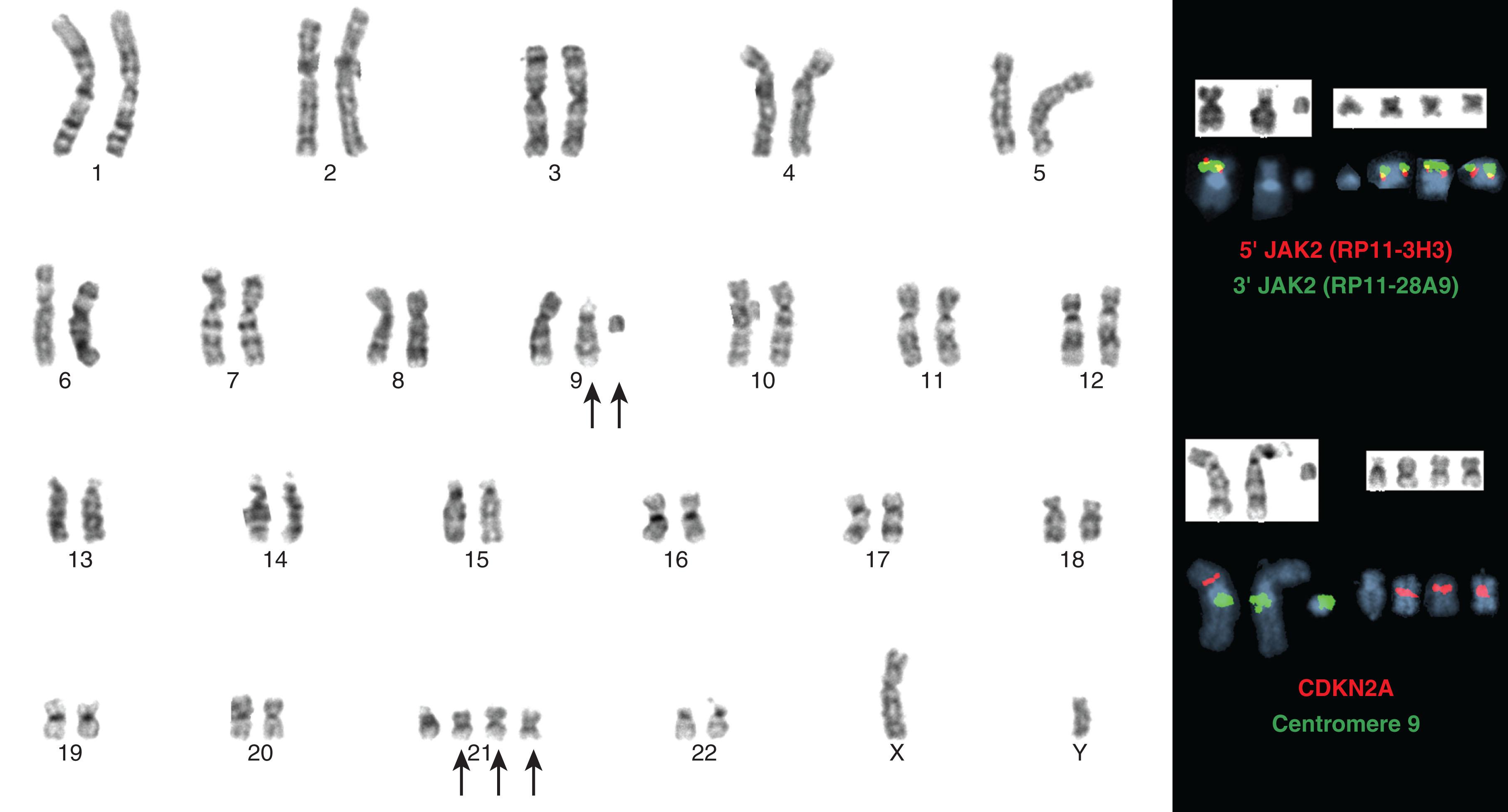 Figure 57.31, A GAIN OF JAK2 IN A PATIENT WITH MYELODYSPLASTIC SYNDROME.