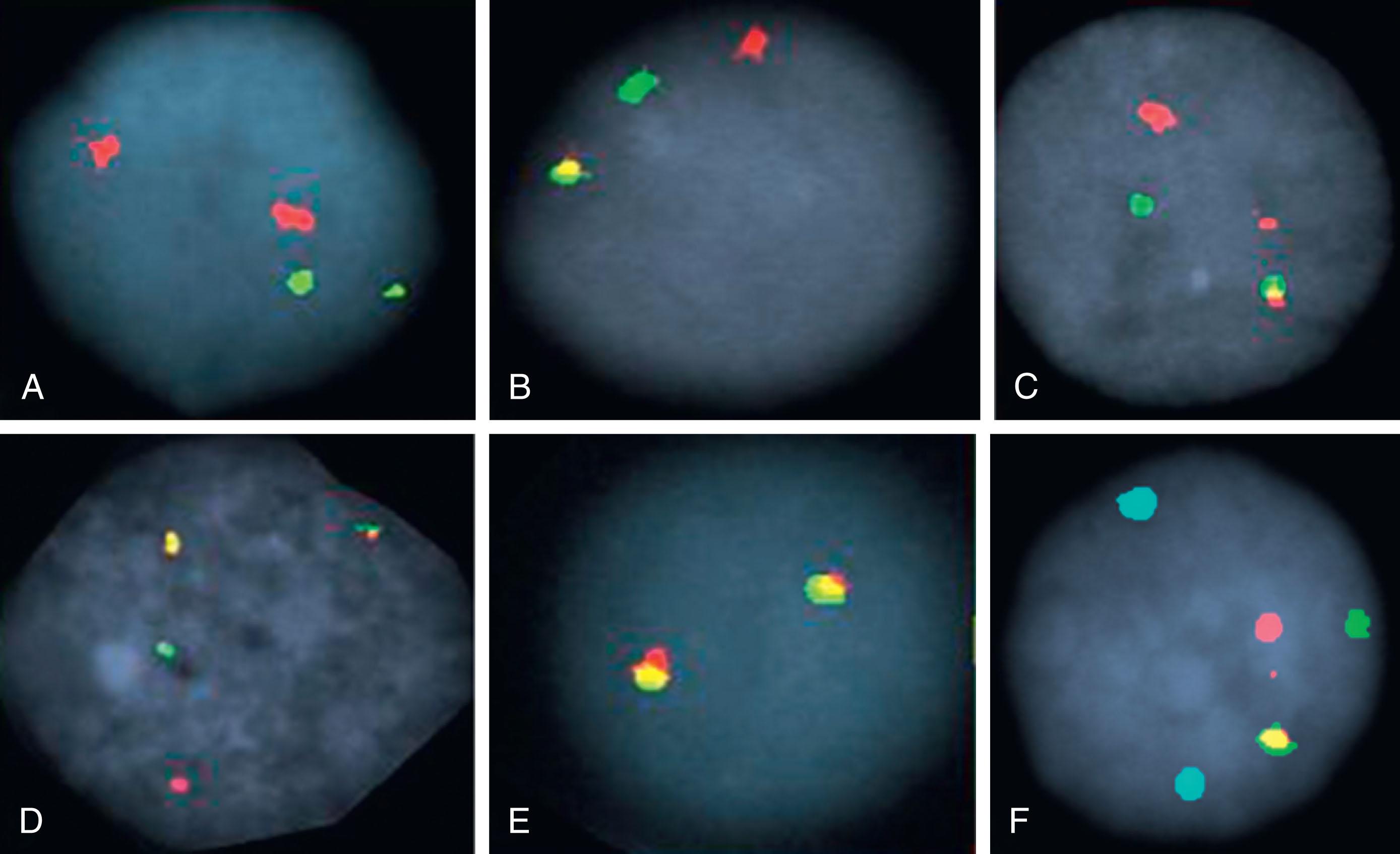 Figure 57.4, FOUR DIFFERENT PROBE STRATEGIES FOR DETECTION OF CHROMOSOMAL TRANSLOCATIONS (SEE TEXT FOR DETAILS).