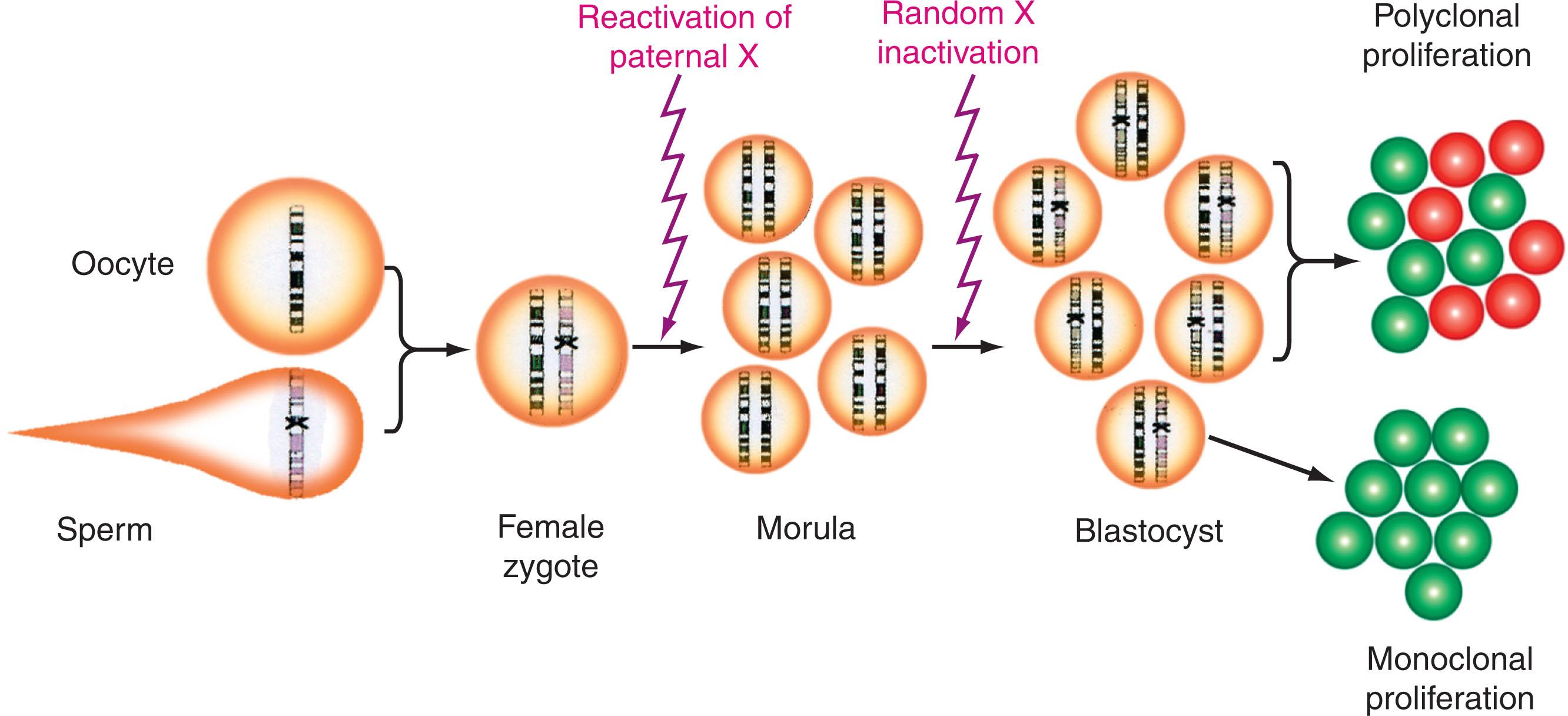 Figure 57.7, X-CHROMOSOME–LINKED ENZYME GLUCOSE-6-PHOSPHATE DEHYDROGENASE (G6PD) AS A MARKER TO INVESTIGATE CLONAL DEVELOPMENT OF HUMAN HEMATOPOIETIC DISORDERS.