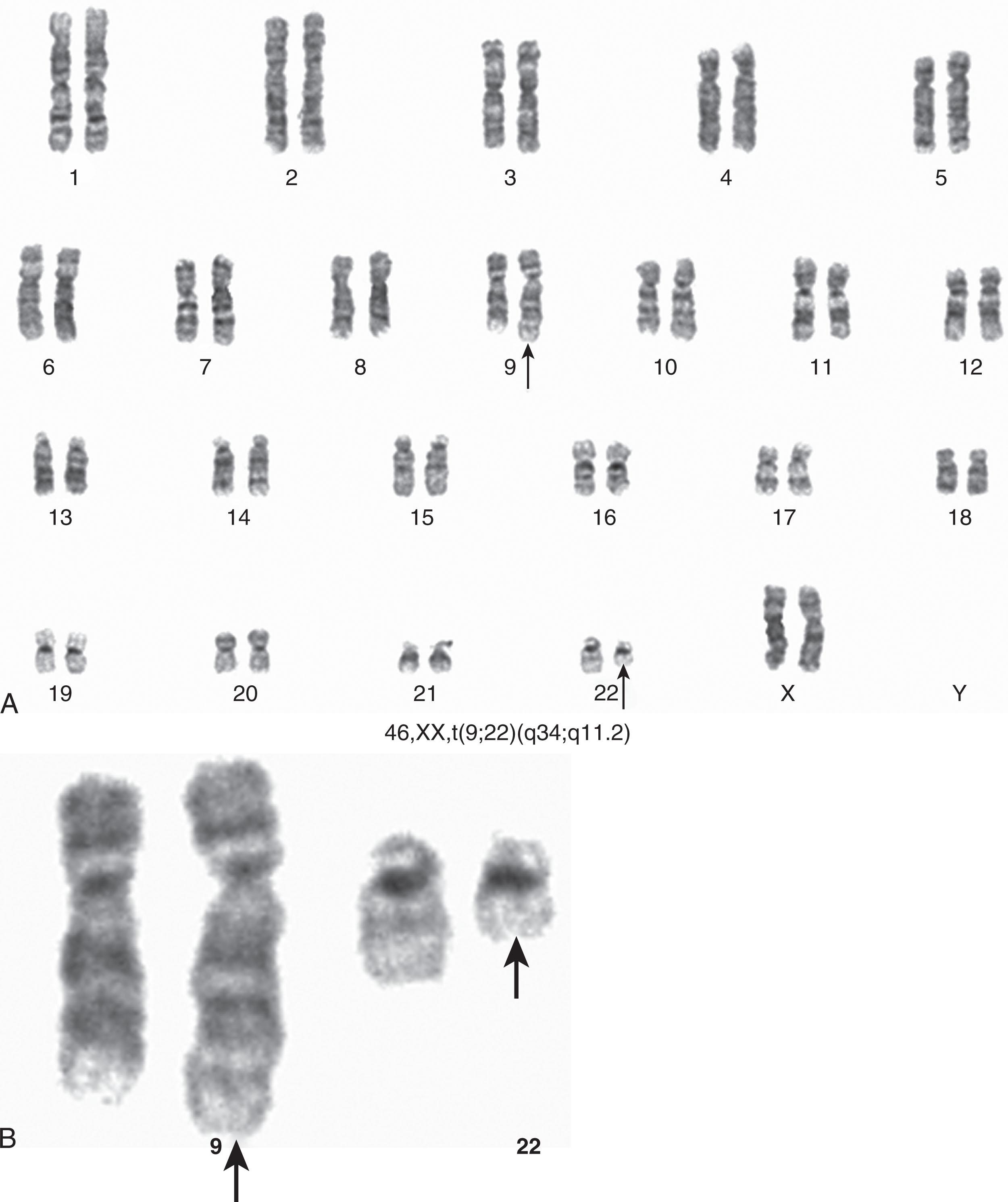 Figure 57.8, (A) The karyotype of a female patient showing a balanced t(9;22)(q34;q11.2), also known as the Ph chromosome. (B) Isolated t(9;22) showing two-thirds of the long arms of chromosome 22 translocated to one homologue of chromosome 9.